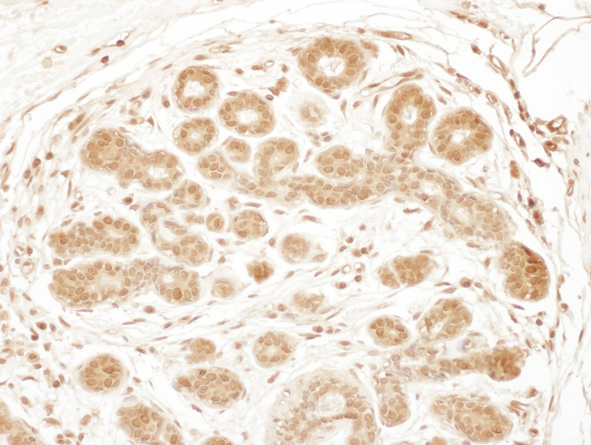 Immunohistochemistry;RSK3 Antibody[NBP3-29482]Detection of human RSK3 by immunohistochemistry. Sample: FFPE section of human breast carcinoma. Antibody: Affinity purified rabbit anti-RSK3  used at a dilution of 1:1,000 . Detection: DAB. Counterstain: IHC Hematoxylin .