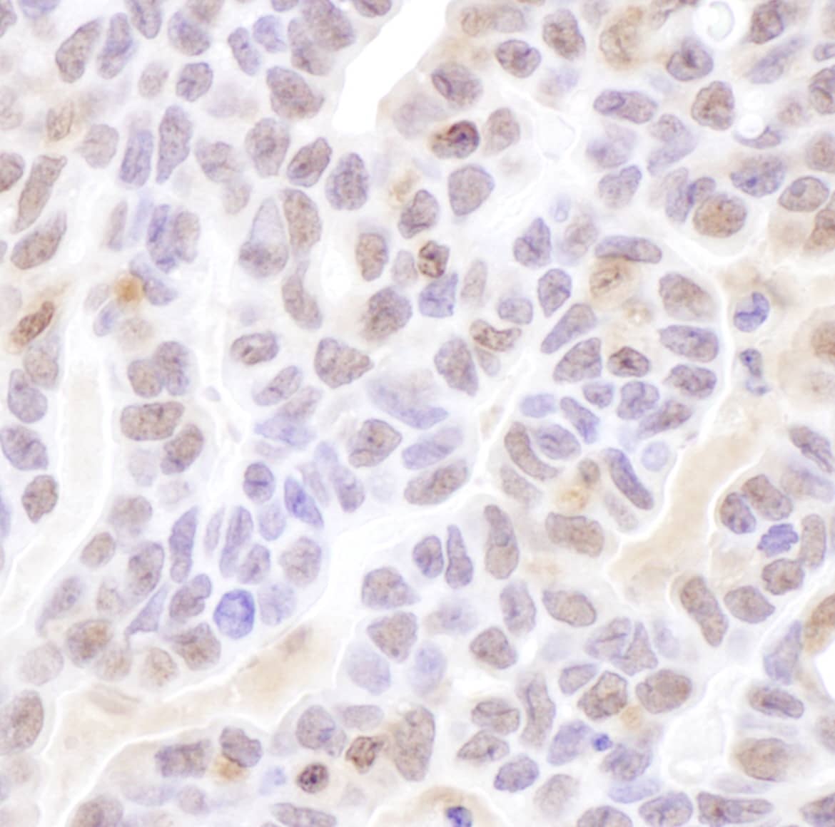 Immunohistochemistry;Coilin Antibody[NBP3-29488]Detection of human Coilin by immunohistochemistry. Sample: FFPE section of human ovarian carcinoma. Antibody: Affinity purified rabbit anti-Coilin  used at a dilution of 1:1,000 . Detection: DAB. Counterstain: Hematoxylin .