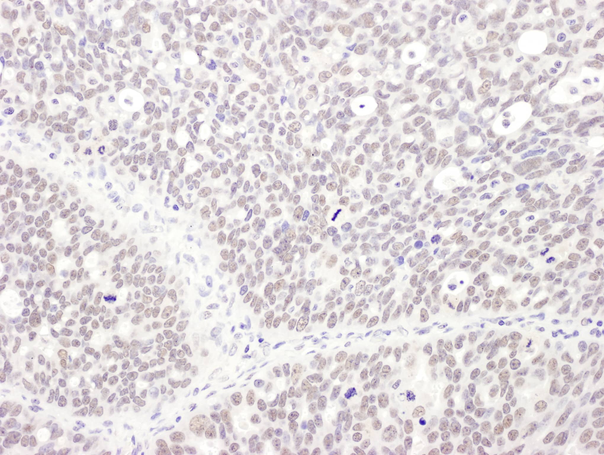 Immunohistochemistry;MEPCE Antibody[NBP3-29492]Detection of human MEPCE by immunohistochemistry. Sample: FFPE section of human ovarian carcinoma. Antibody: Affinity purified rabbit anti-MEPCE  used at a dilution of 1:1,000 . Detection: DAB. Counterstain: IHC Hematoxylin .