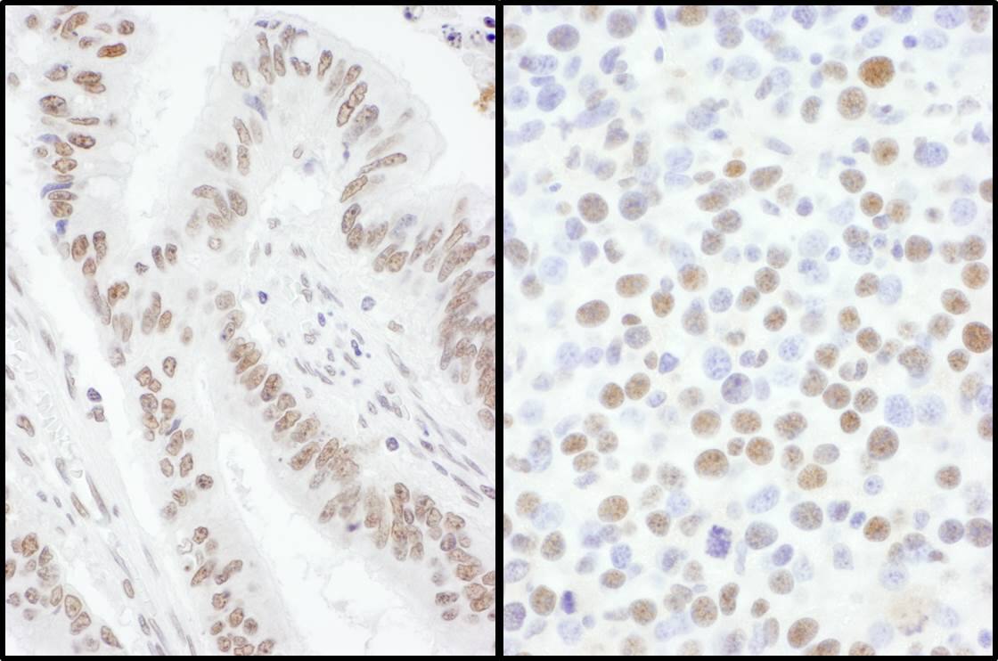 Immunohistochemistry;SFRS7 Antibody[NBP3-29494]Detection of human and mouse SRSF7 by immunohistochemistry. Sample: FFPE sections of human colon carcinoma  and mouse renal cell carcinoma . Antibody: Affinity purified rabbit anti-SRSF7  used at a dilution of 1:5,000  and 1:1,000 . Detection: DAB