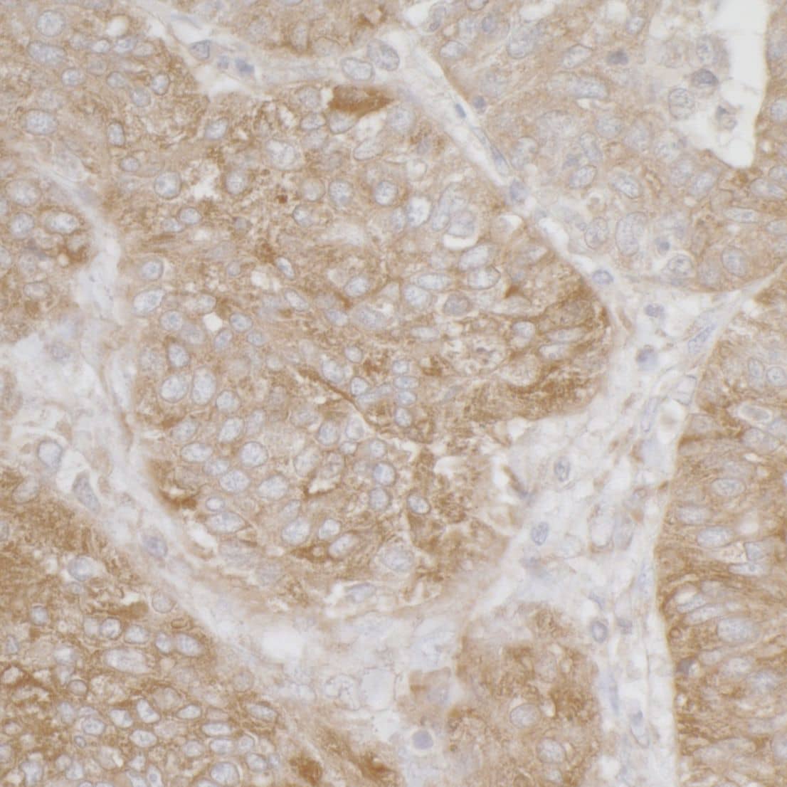 Immunohistochemistry;RPS3A Antibody[NBP3-29536]Detection of human Ribosomal Protein S3A by immunohistochemistry. Sample: FFPE section of human ovarian carcinoma. Antibody: Affinity purified rabbit anti-Ribosomal Protein S3A  used at a dilution of 1:1,000 . Detection: DAB