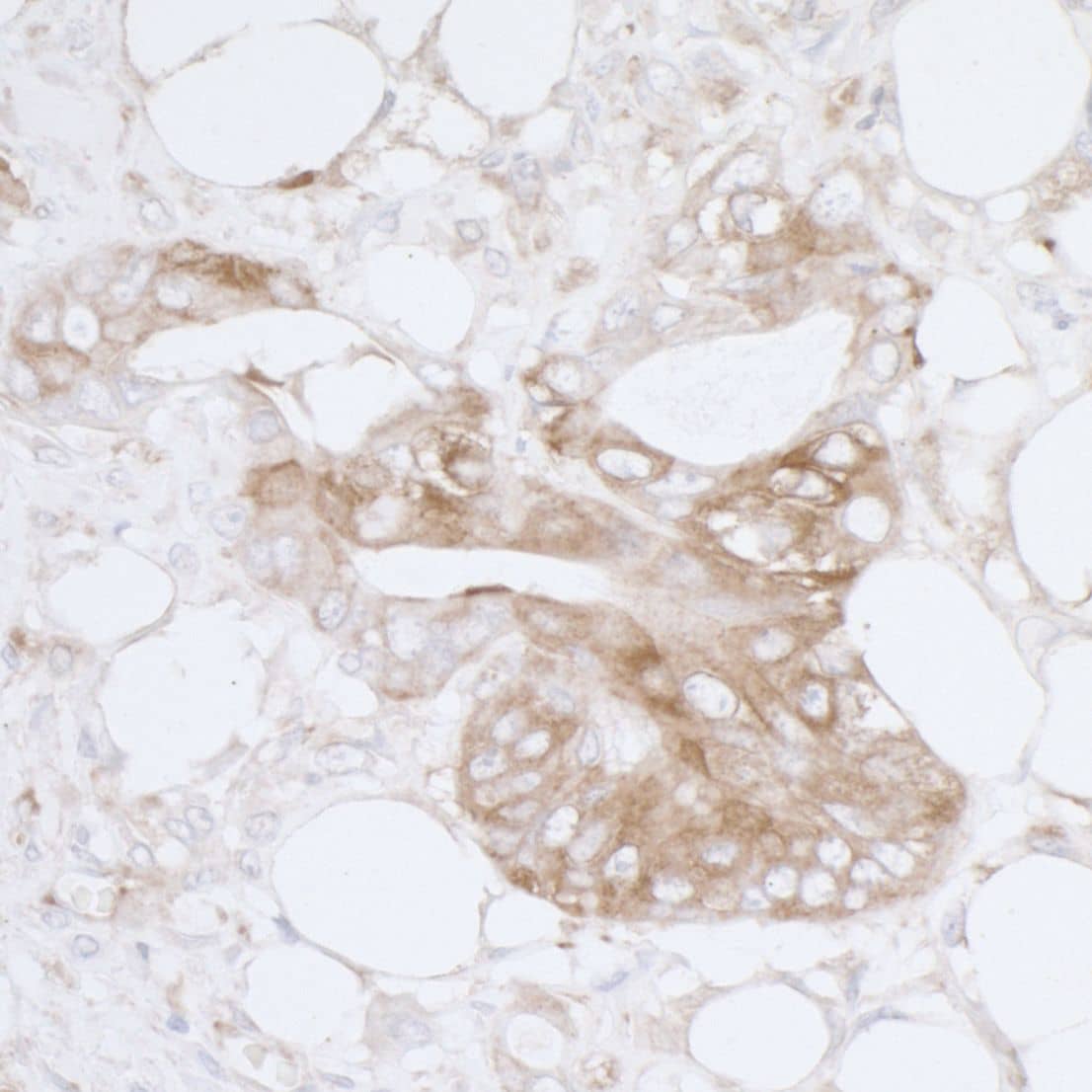 Immunohistochemistry;MVP Antibody[NBP3-29537]Detection of human MVP by immunohistochemistry. Sample: FFPE section of human colon carcinoma. Antibody: Affinity purified rabbit anti-MVP  used at a dilution of 1:1,000 . Detection: DAB