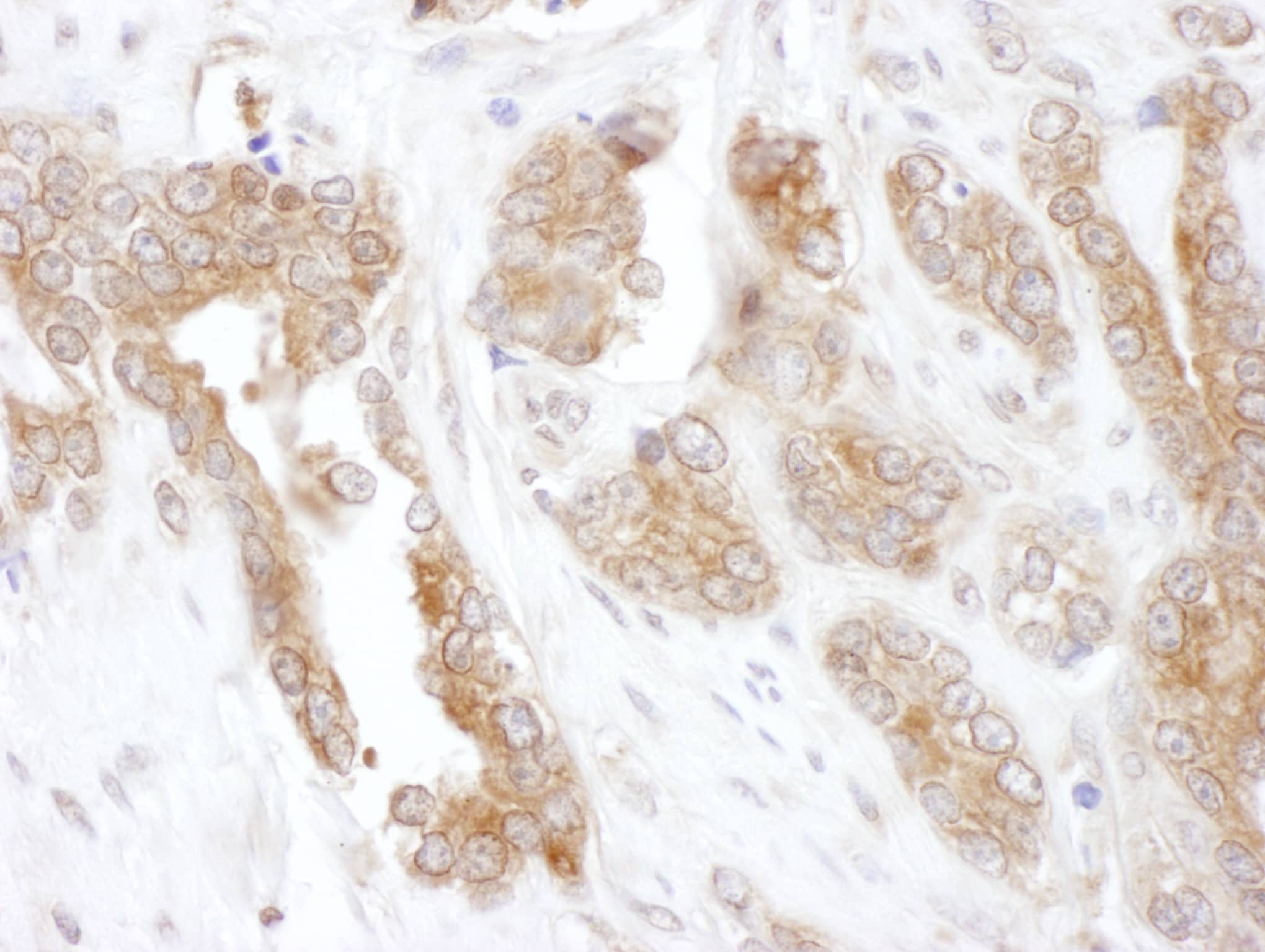 Immunohistochemistry:[NBP3-29559]-Detection of human CCT5 by immunohistochemistry. Sample: FFPE section of human prostate carcinoma. Antibody: Affinity purified rabbit anti-CCT5 used at a dilution of 1: 200. Detection: DAB. Counterstain: hematoxylin.