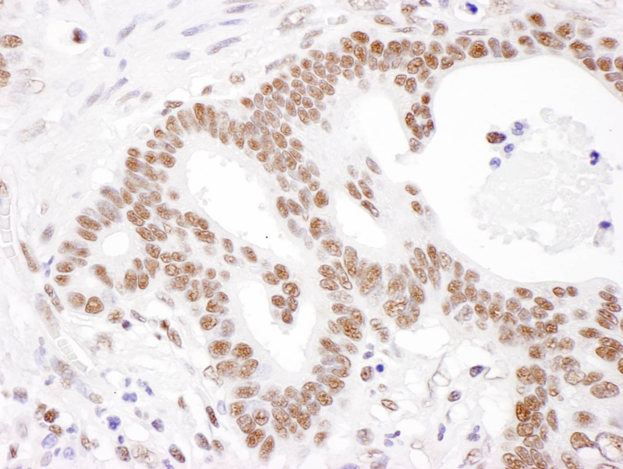 Immunohistochemistry:[NBP3-29560]-Detection of human PABPN1 by immunohistochemistry. Sample: FFPE section of human stomach carcinoma. Antibody: Affinity purified rabbit anti-PABPN1 used at a dilution of 1: 1,000. Detection: DAB. Counterstain: hematoxylin.