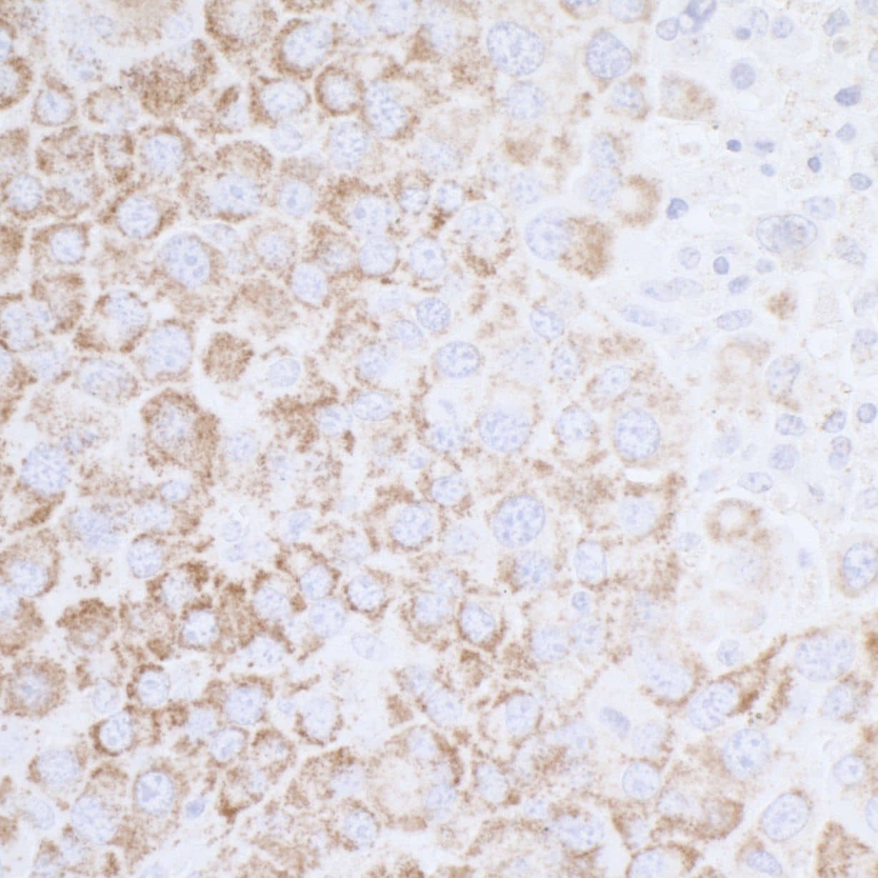 Immunohistochemistry;ATP5A Antibody[NBP3-29561]Detection of mouse ATP5A1 by immunohistochemistry. Sample: FFPE section of mouse renal cell carcinoma. Antibody: Affinity purified rabbit anti-ATP5A1  used at a dilution of 1:5,000 . Detection: DAB