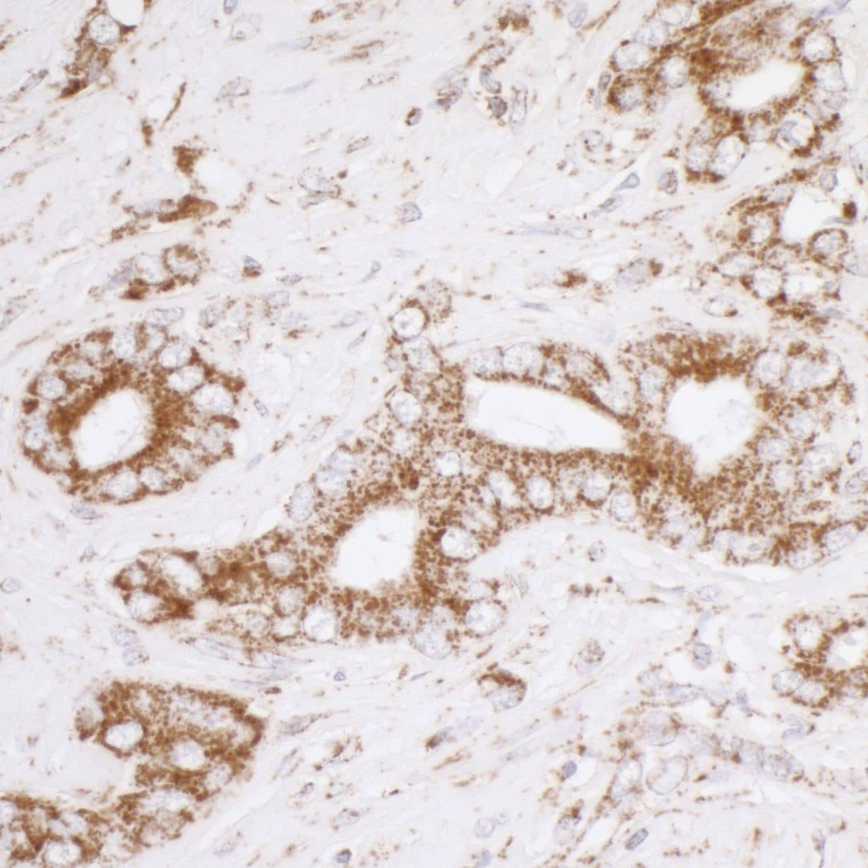 Immunohistochemistry;ATP5A Antibody[NBP3-29558]Detection of human ATP5A1 by immunohistochemistry. Sample: FFPE section of human prostate carcinoma. Antibody: Affinity purified rabbit anti-ATP5A1  used at a dilution of 1:5,000 . Detection: DAB