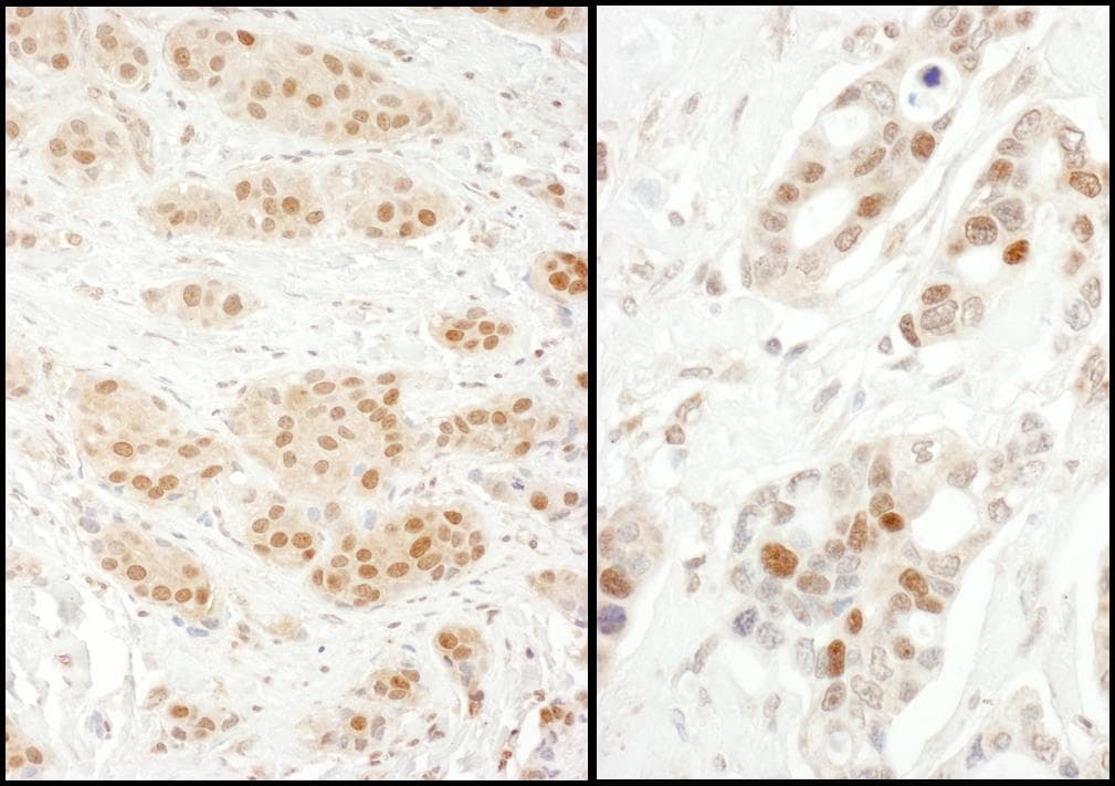 Immunohistochemistry;Exportin-5 Antibody[NBP3-29561]Detection of human Exportin-5 by immunohistochemistry. Samples: FFPE sections of human breast carcinoma  and ovarian carcinoma . Antibody: Affinity purified rabbit anti-Exportin-5  used at a dilution of 1:1,000 . Detection: DAB