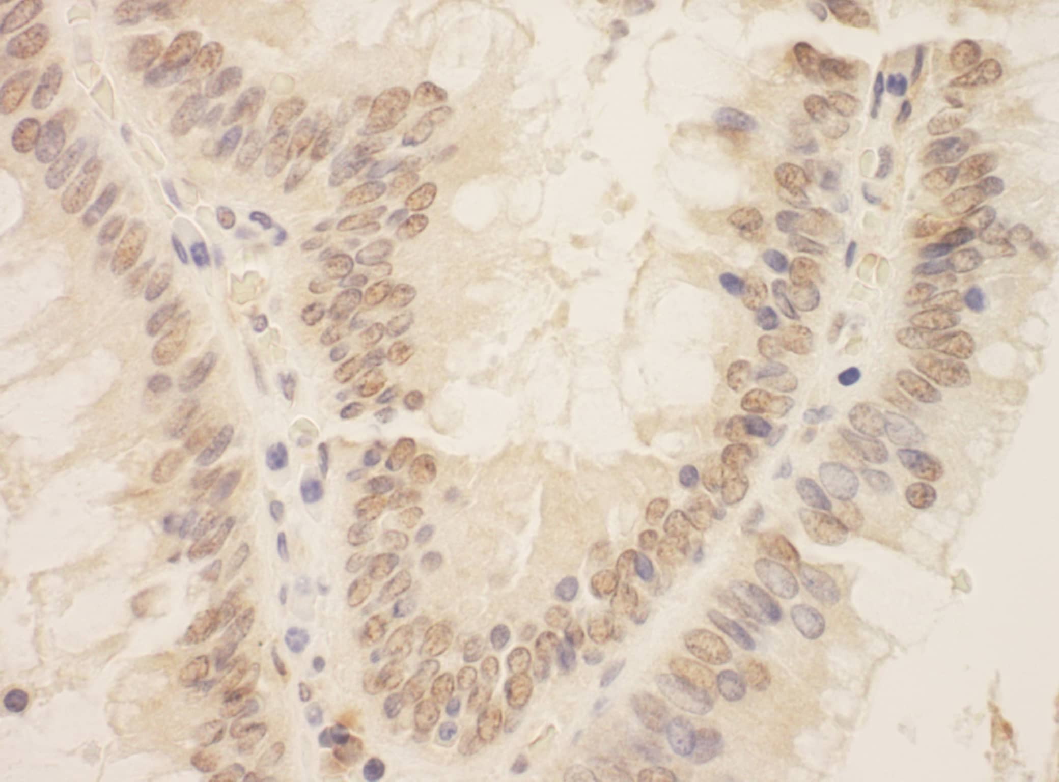 Immunohistochemistry:[NBP3-29586]-Detection of human ZEB2/SIP by immunohistochemistry. Sample: FFPE section of human colon carcinoma. Antibody: Affinity purified rabbit anti-ZEB2/SIP used at a dilution of 1: 200. Detection: DAB