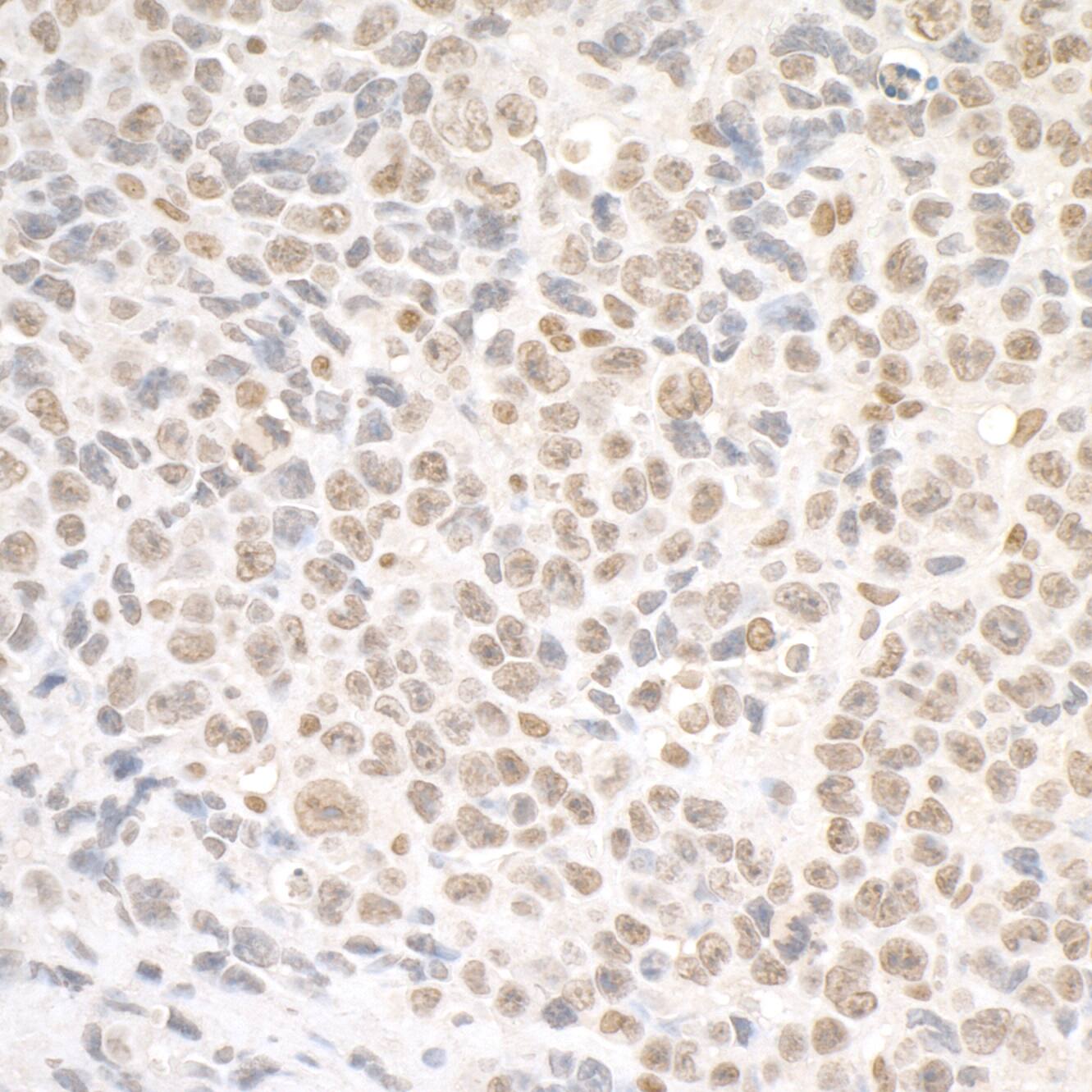 Immunohistochemistry;SMC1 Antibody[NBP3-29562]Detection of mouse SMC1 by immunohistochemistry. Sample: FFPE section of mouse colon carcinoma CT26. Antibody: Affinity purified rabbit anti-SMC1  used at a dilution of 1:5,000 . Detection: DAB