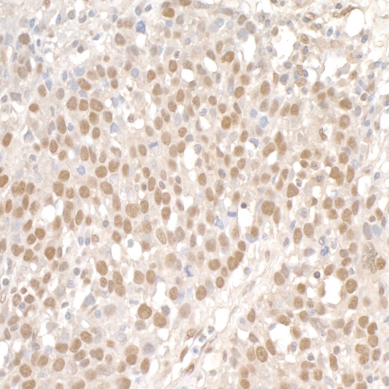 Immunohistochemistry;SMC1 Antibody[NBP3-29588]Detection of human SMC1 by immunohistochemistry. Sample: FFPE section of human ovarian carcinoma. Antibody: Affinity purified rabbit anti-SMC1  used at a dilution of 1:5,000 . Detection: DAB