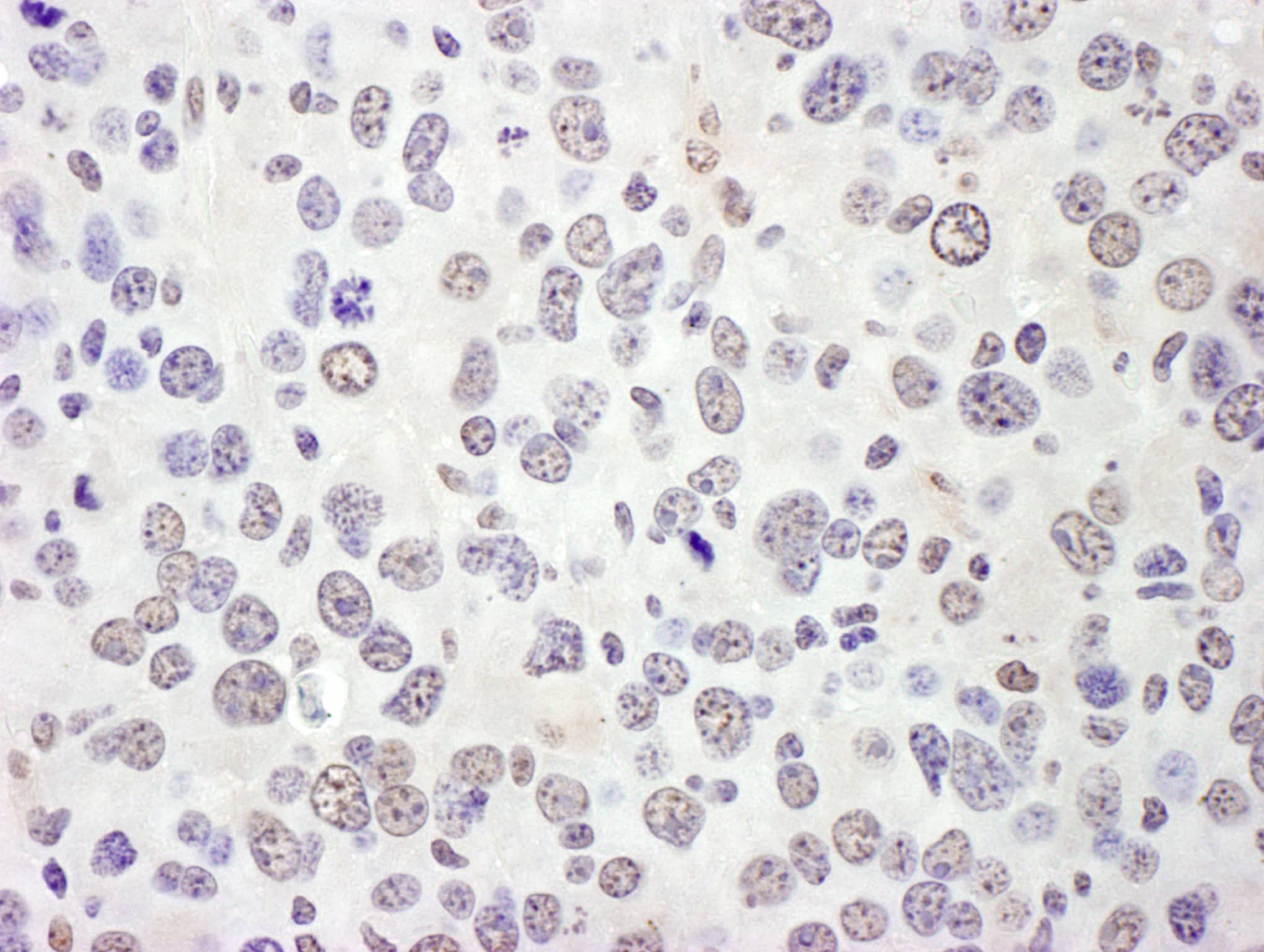 Immunohistochemistry:[NBP3-29604]-Detection of mouse eIF4AIII/EIF4A3 by immunohistochemistry. Sample: FFPE section of mouse renal carcinoma. Antibody: Affinity purified rabbit anti-eIF4AIII/EIF4A3 used at a dilution of 1: 200. Detection: DAB