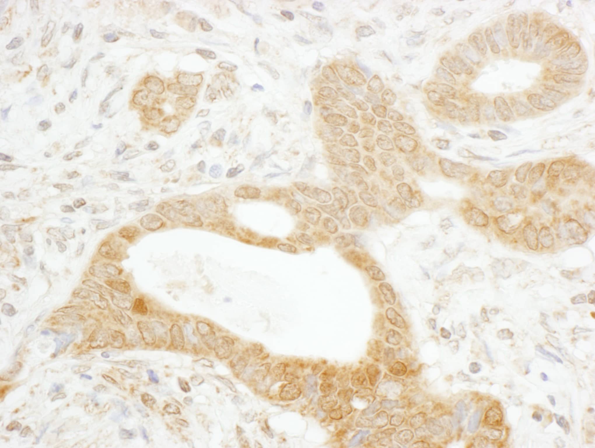 Immunohistochemistry;Tankyrase 1 Antibody[NBP3-29588]Detection of human Tankyrase 1 by immunohistochemistry. Sample: FFPE section of human stomach carcinoma. Antibody: Affinity purified rabbit anti-Tankyrase 1  used at a dilution of 1:1,000 . Detection: DAB