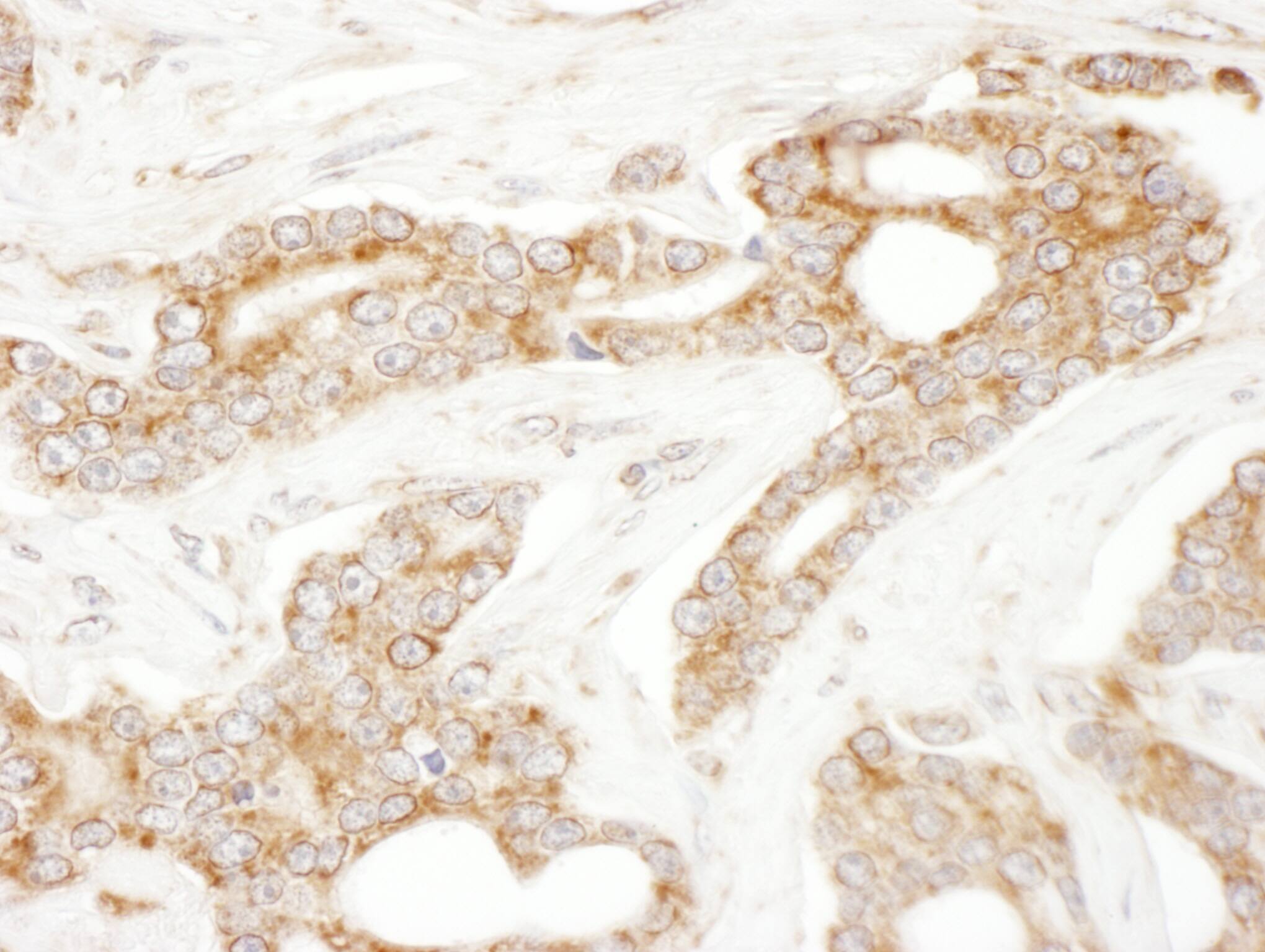 Immunohistochemistry;CLIP170 Antibody[NBP3-29628]Detection of human CLIP170 by immunohistochemistry. Sample: FFPE section of human prostate carcinoma. Antibody: Affinity purified rabbit anti-CLIP170  used at a dilution of 1:1,000 . Detection: DAB. Counterstain: Hematoxylin .