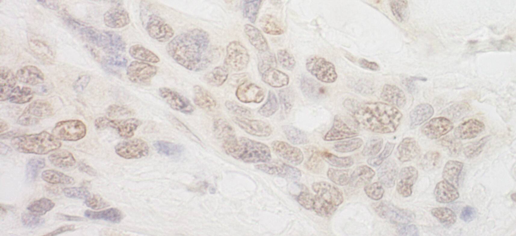 Immunohistochemistry:[NBP3-29630]-Detection of human IBP160 by immunohistochemistry. Sample: FFPE section of human ovarian carcinoma. Antibody: Affinity purified rabbit anti-IBP160 used at a dilution of 1: 200. Detection: DAB