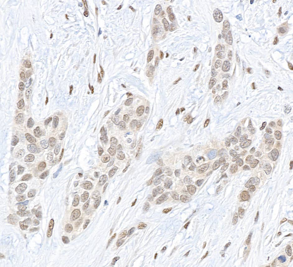 Immunohistochemistry;CBX4 Antibody[NBP3-29649]Detection of human Pc2 by immunohistochemistry. Sample: FFPE section of human bladder carcinoma. Antibody: Affinity purified rabbit anti- Pc2  used at a dilution of 1:1,000 . Detection: DAB