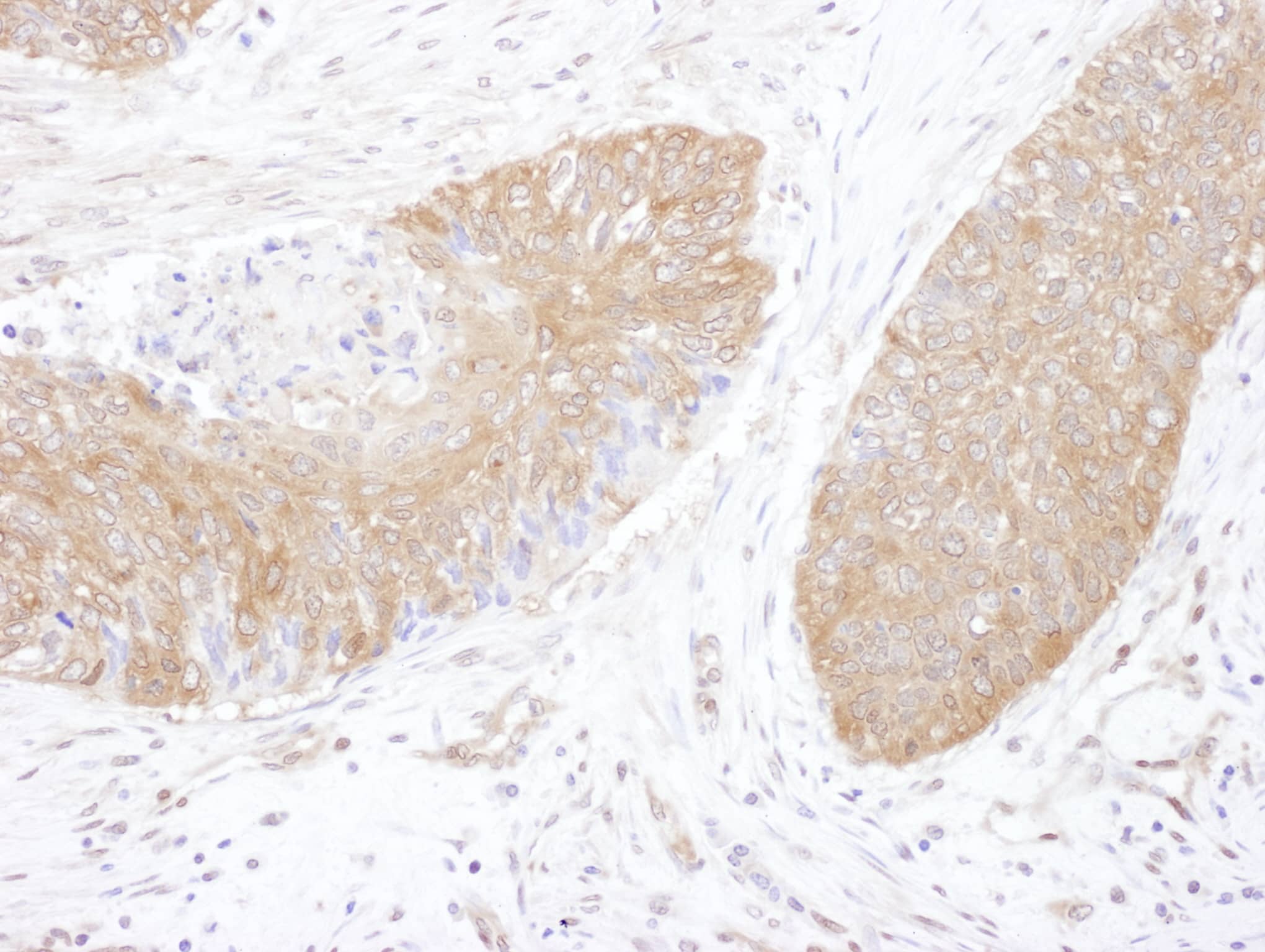 Immunohistochemistry:[NBP3-29670]-Detection of human CCT5 by immunohistochemistry. Sample: FFPE section of human lung carcinoma. Antibody: Affinity purified rabbit anti-CCT5 used at a dilution of 1: 200. Detection: DAB. Counterstain: hematoxylin.