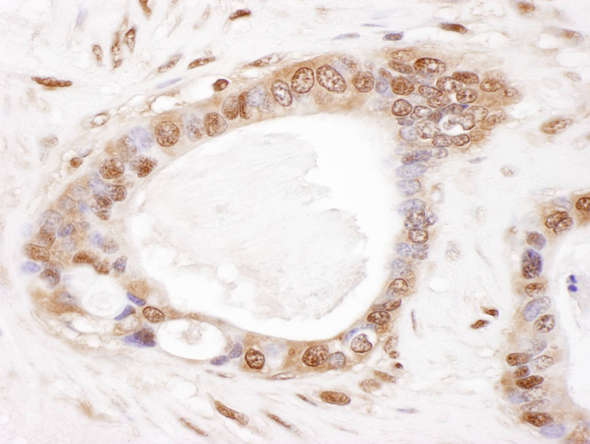 Immunohistochemistry;Proteasome 20S beta2 Antibody[NBP3-29688]Detection of human PSMB2 by immunohistochemistry. Sample: FFPE section of human ovarian carcinoma. Antibody: Affinity purified rabbit anti-PSMB2  used at a dilution of 1:5,000 . Detection: DAB. Counterstain: hematoxylin .