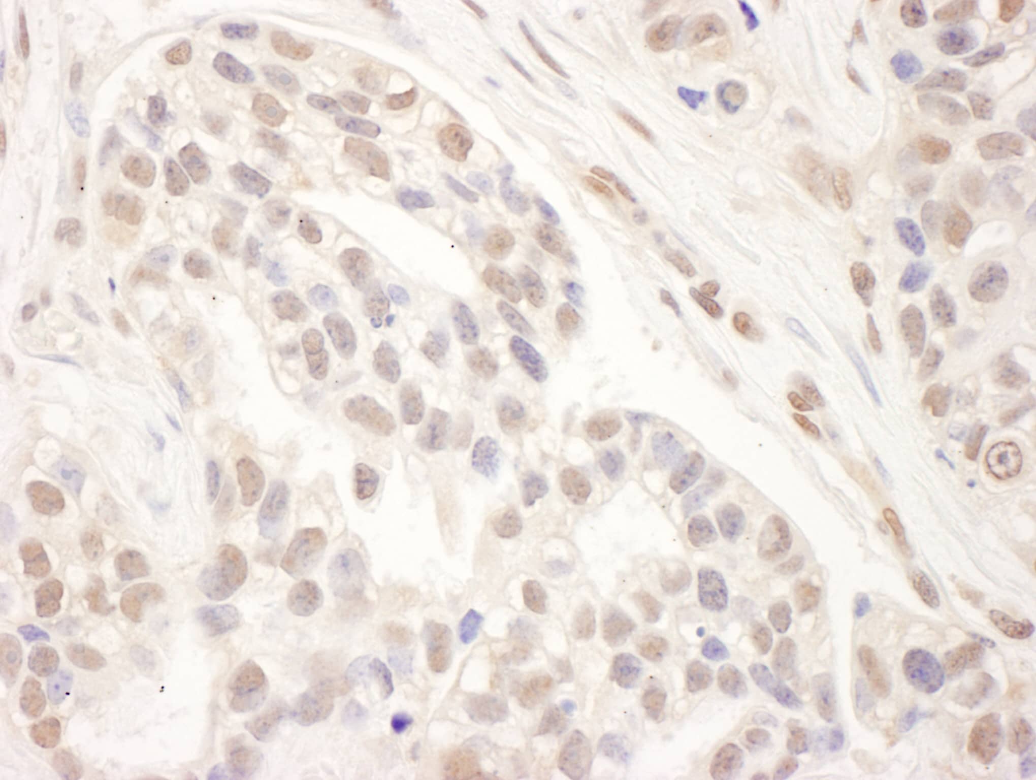 Immunohistochemistry;TRAP220/MED1 Antibody[NBP3-29689]Detection of human MED1 by immunohistochemistry. Sample: FFPE section of human breast carcinoma. Antibody: Affinity purified goat anti-MED1  used at a dilution of 1:1,000 . Detection: DAB