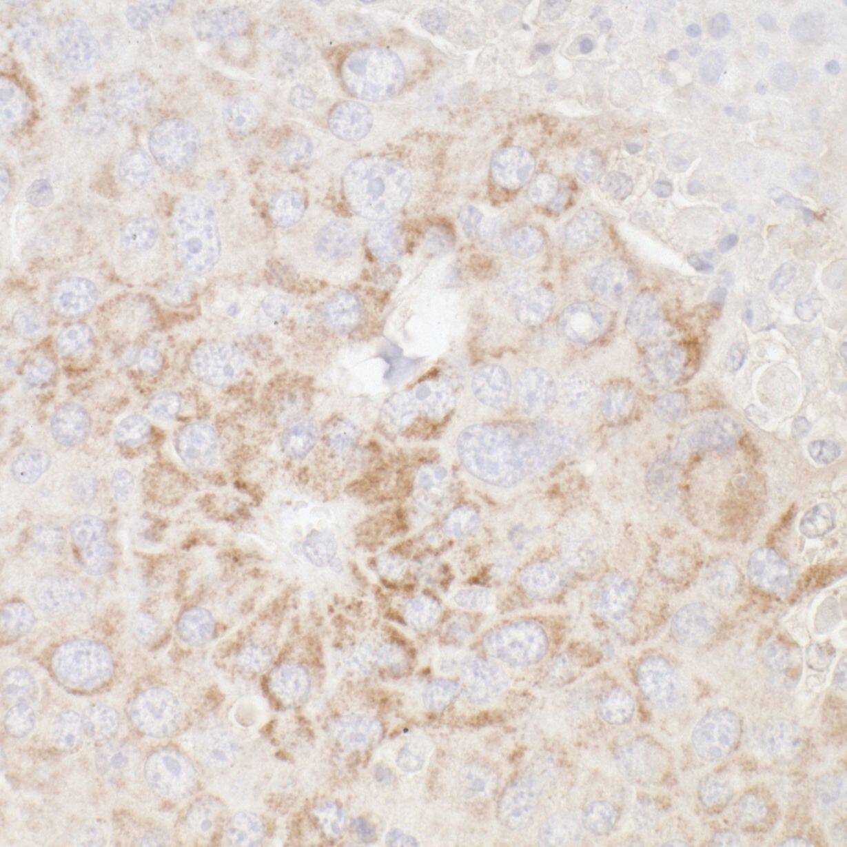 Immunohistochemistry;ATP5A Antibody[NBP3-29711]Detection of mouse ATP5A1 by immunohistochemistry. Sample: FFPE section of mouse renal cell carcinoma. Antibody: Affinity purified rabbit anti-ATP5A1  used at a dilution of 1:5,000 . Detection: DAB