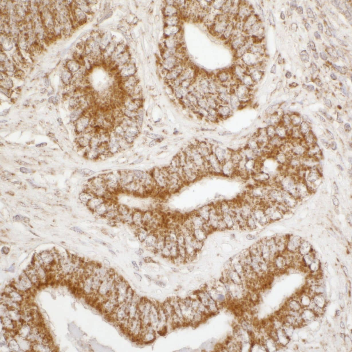 Immunohistochemistry;ATP5A Antibody[NBP3-29712]Detection of human ATP5A1 by immunohistochemistry. Sample: FFPE section of human prostate carcinoma. Antibody: Affinity purified rabbit anti-ATP5A1  used at a dilution of 1:5,000 . Detection: DAB