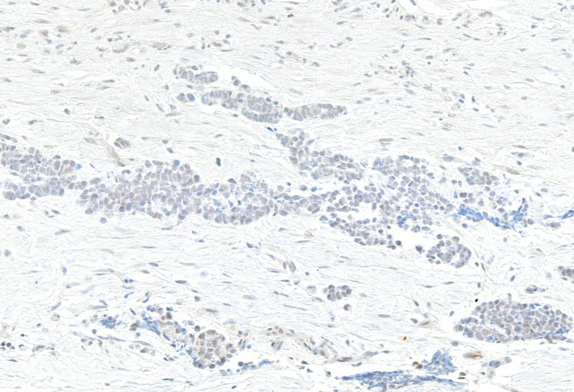 Immunohistochemistry;KAT4/TBP Associated Factor 1 Antibody[NBP3-29732]Detection of human TAF1 by immunohistochemistry. Sample: FFPE section of bladder carcinoma. Antibody: Rabbit anti-TAF1 antibody  used at 1:1000 . Secondary: HRP-conjugated goat anti-rabbit IgG . Substrate: DAB.