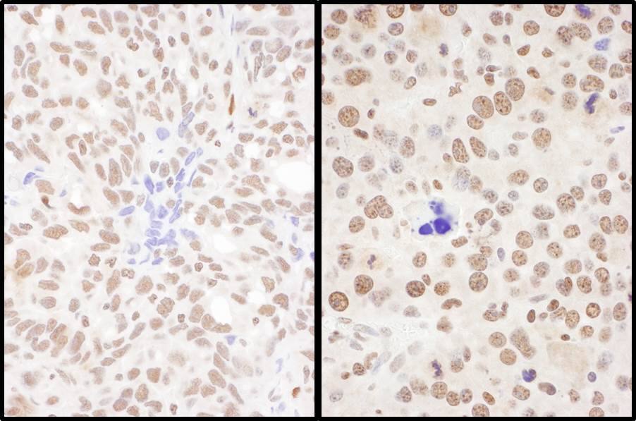 Immunohistochemistry;SFRS7 Antibody[NBP3-29732]Detection of human and mouse SRSF7 by immunohistochemistry. Sample: FFPE sections of human ovarian carcinoma  and mouse renal cell carcinoma . Antibody: Affinity purified rabbit anti-SRSF7  used at a dilution of 1:1,000 . Detection: DAB