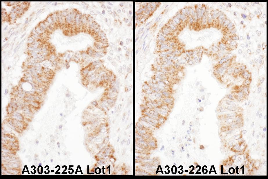 Immunohistochemistry:[NBP3-29749]-Detection of human TFAM by immunohistochemistry. Samples: FFPE serial sections of human stomach carcinoma. Antibody: Affinity purified rabbit anti-TFAM used at a dilution of 1: 1,000. Detection: DAB