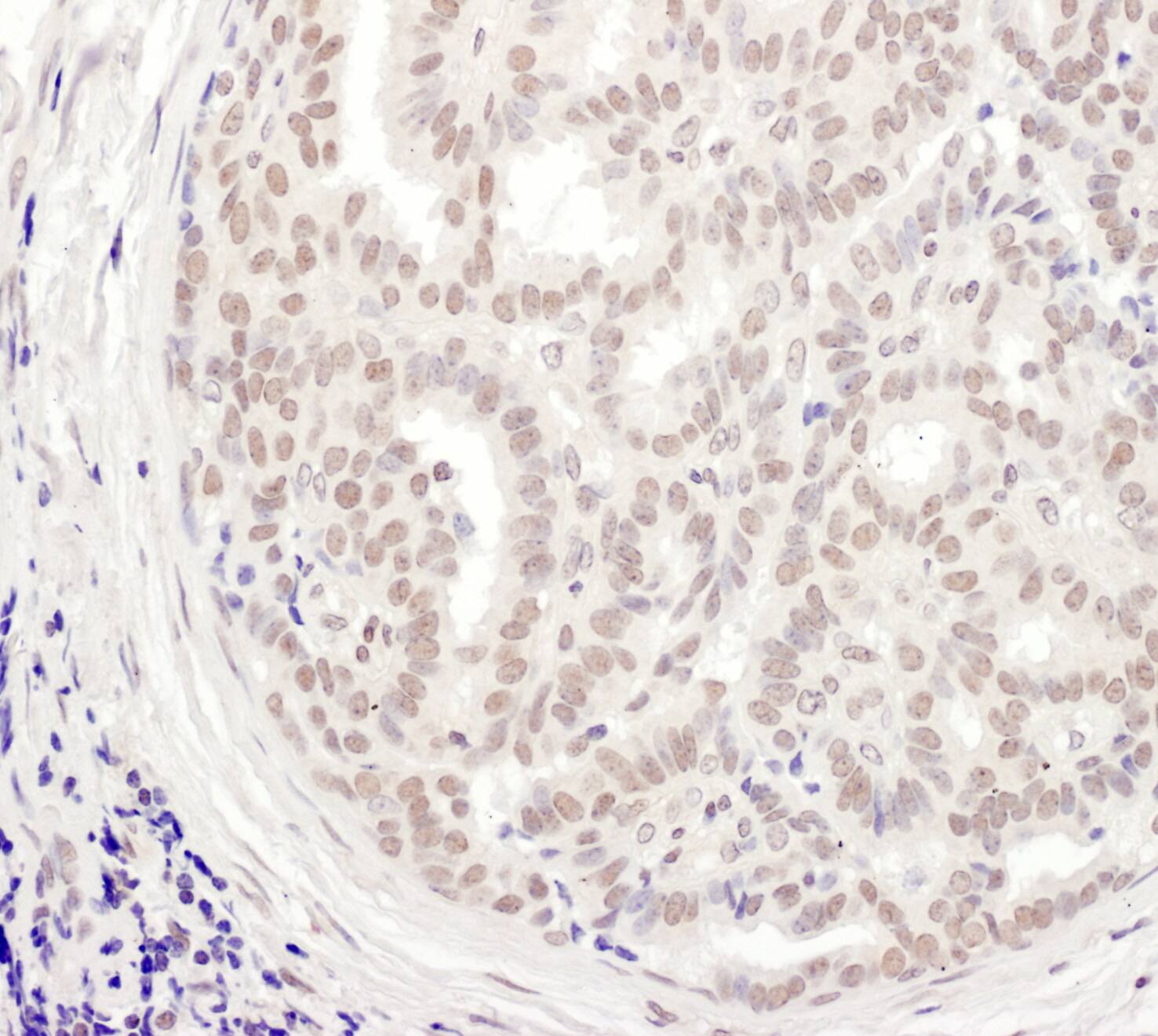 Immunohistochemistry;MEPCE Antibody[NBP3-29768]Detection of human MEPCE by immunohistochemistry. Sample: FFPE section of human breast carcinoma. Antibody: Affinity purified rabbit anti-MEPCE  used at a dilution of 1:1,000 . Detection: DAB