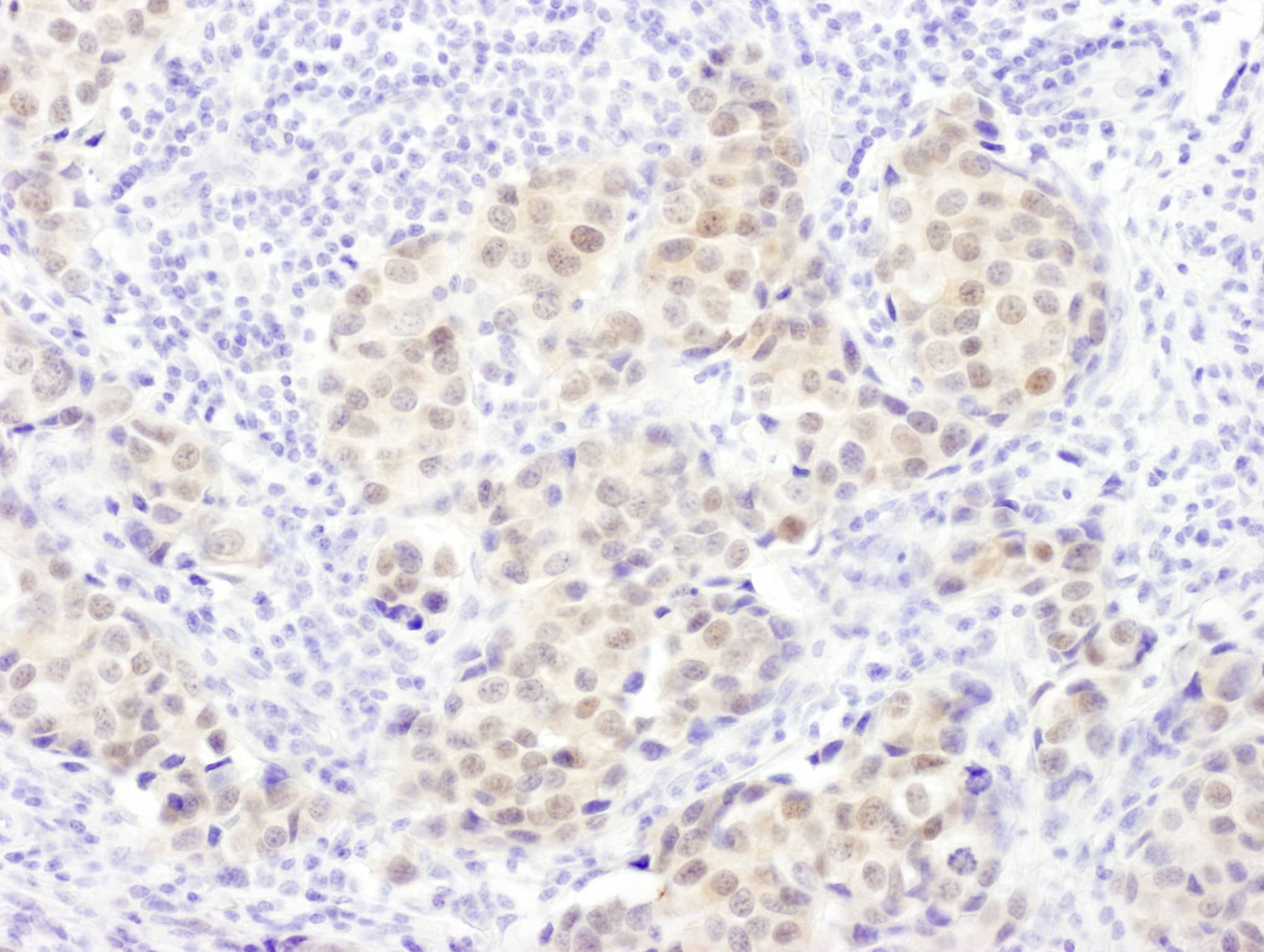 Immunohistochemistry;PSMB5 Antibody[NBP3-29771]Detection of human PSMB5 by immunohistochemistry. Sample: FFPE section of human breast carcinoma. Antibody: Affinity purified rabbit anti-PSMB5  used at a dilution of 1:5,000 . Detection: DAB