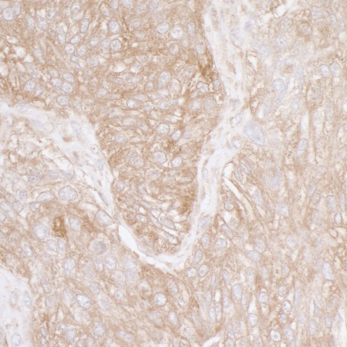 Immunohistochemistry;RPS3A Antibody[NBP3-29772]Detection of human Ribosomal Protein S3A by immunohistochemistry. Sample: FFPE section of human ovarian carcinoma. Antibody: Affinity purified rabbit anti-Ribosomal Protein S3A  used at a dilution of 1:5,000 . Detection: DAB