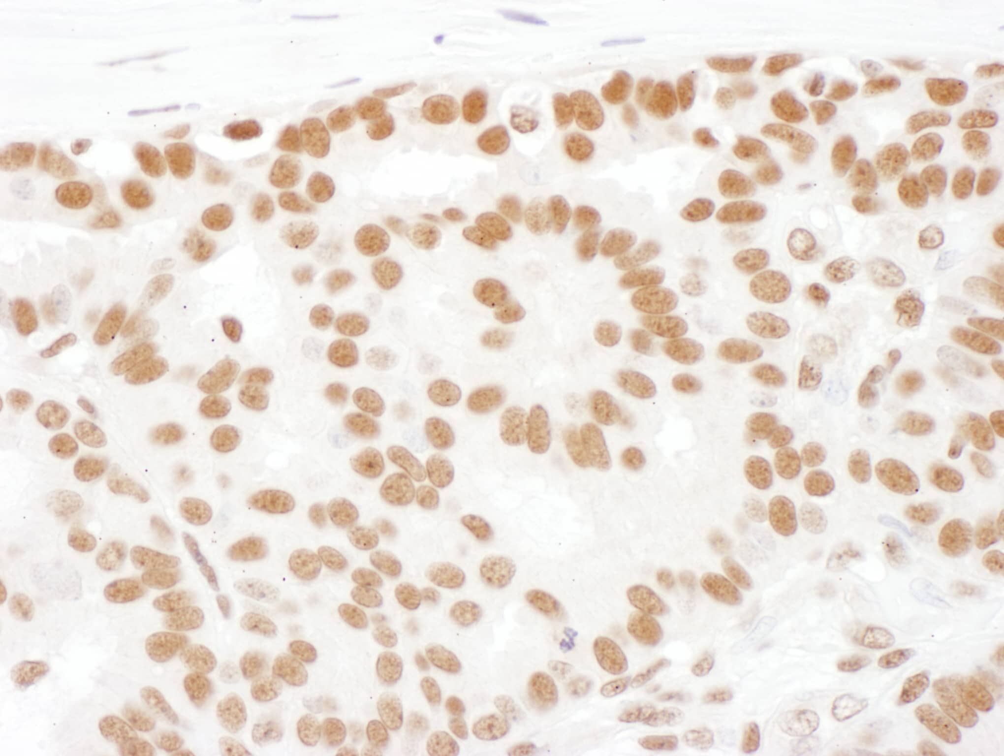 Immunohistochemistry:[NBP3-29789]-Detection of human SF1 by immunohistochemistry. Sample: FFPE section of human breast carcinoma. Antibody: Affinity purified rabbit anti-SF1 used at a dilution of 1: 200. Detection: DAB. Counterstain: Hematoxylin.