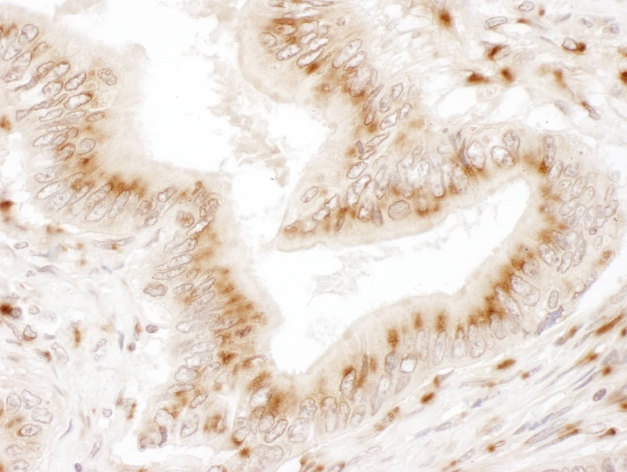 Immunohistochemistry;TGN38 Antibody[NBP3-29788]Detection of human TGOLN2 by immunohistochemistry. Sample: FFPE section of human colon carcinoma. Antibody: Affinity purified rabbit anti-TGOLN2  used at a dilution of 1:1,000 . Detection: DAB