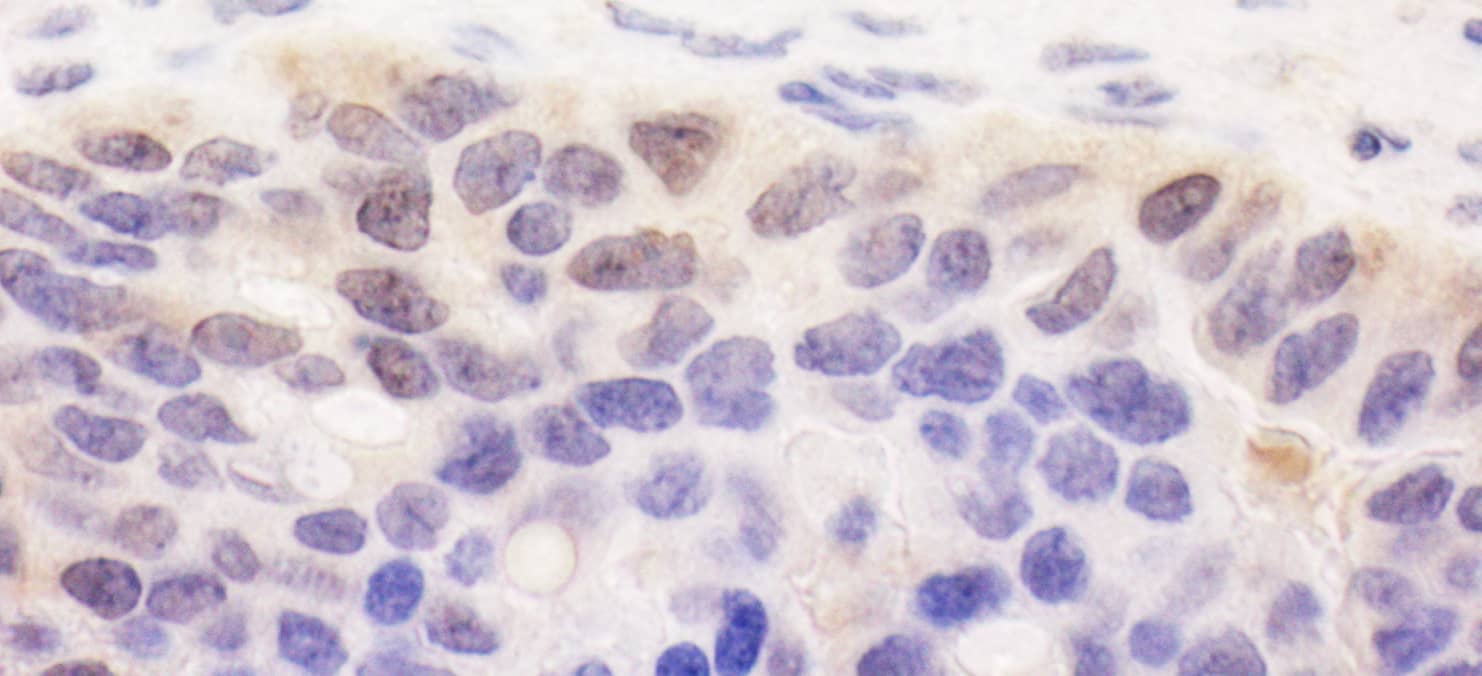 Immunohistochemistry;SPATA2 Antibody[NBP3-29809]Detection of human SPATA2 by immunohistochemistry. Sample: FFPE section of human ovarian carcinoma. Antibody: Affinity purified rabbit anti-SPATA2  used at a dilution of 1:1,000 . Detection: DAB