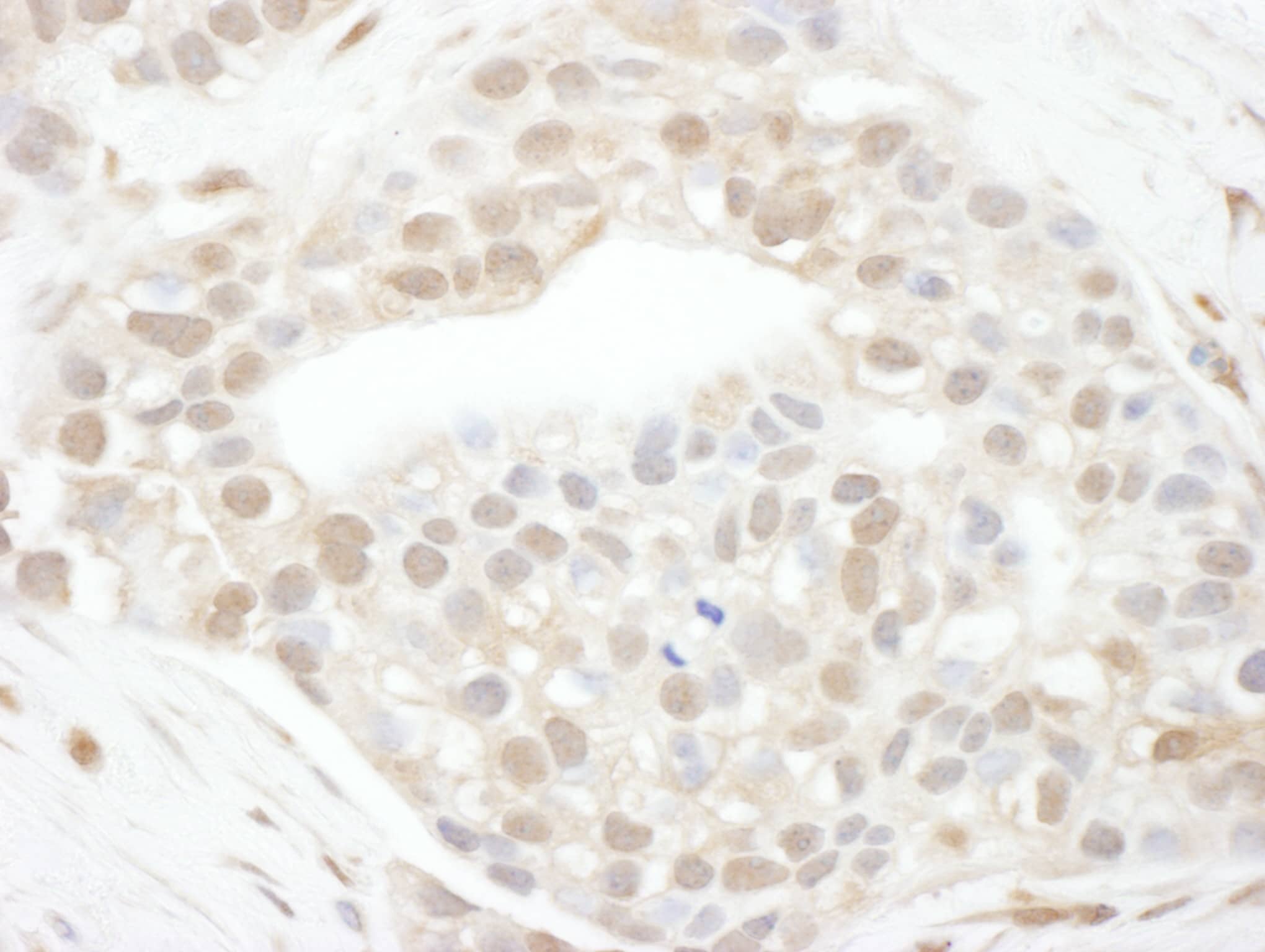 Immunohistochemistry:[NBP3-29811]-Detection of human Cyclin T1 by immunohistochemistry. Sample: FFPE section of human breast carcinoma. Antibody: Affinity purified rabbit anti-Cyclin T1 used at a dilution of 1: 200. Detection: DAB