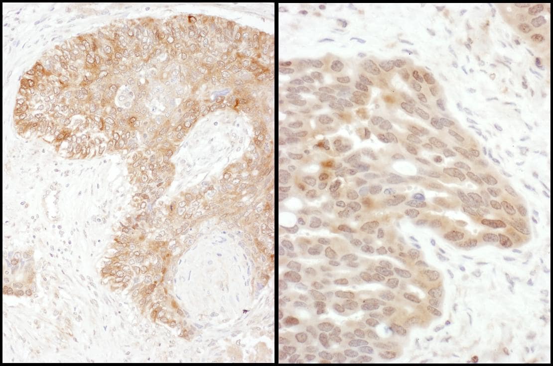 Immunohistochemistry;Thymidylate Synthase Antibody[NBP3-29829]Detection of human TS by immunohistochemistry. Samples: FFPE sections of human ovarian carcinoma  and lung cancer . Antibody: Affinity purified rabbit anti-TS  used at a dilution of 1:1,000 . Detection: DAB