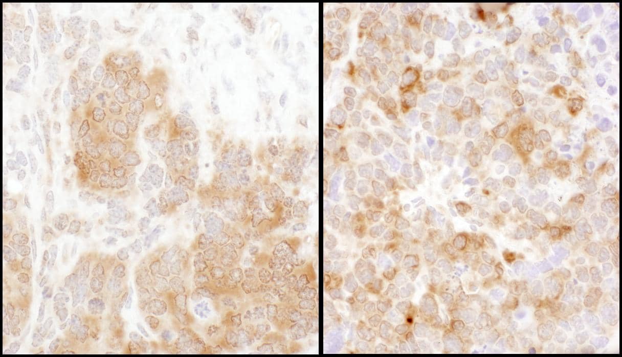 Immunohistochemistry;Thymidylate Synthase Antibody[NBP3-29828]Detection of mouse TS by immunohistochemistry. Samples: FFPE sections of mouse teratoma  and plasmacytoma . Antibody: Affinity purified rabbit anti-TS  used at a dilution of 1:1,000 . Detection: DAB