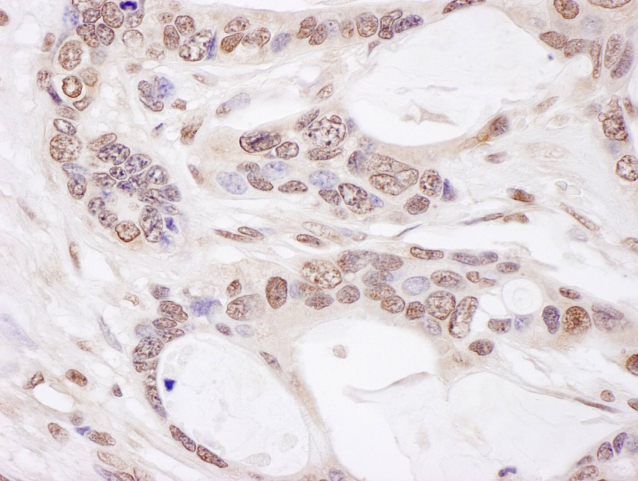 Immunohistochemistry;ZNF828 Antibody[NBP3-29974]Detection of human CHAMP1 by immunohistochemistry. Sample: FFPE section of human ovarian carcinoma. Antibody: Affinity purified rabbit anti-CHAMP1  used at a dilution of 1:1,000 . Detection: DAB