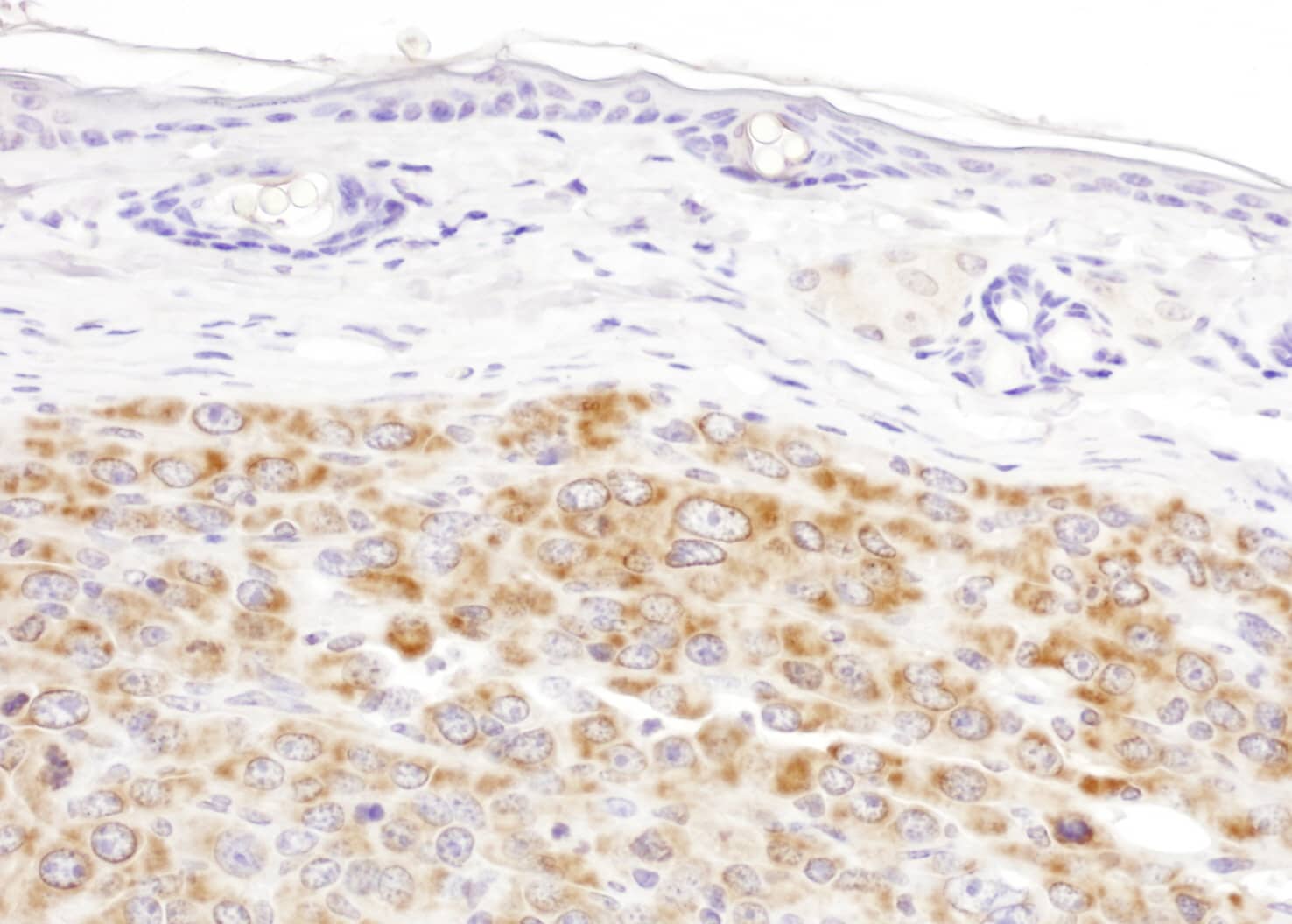 Immunohistochemistry;IDH2 Antibody[NBP3-29975]Detection of mouse IDH2 by immunohistochemistry. Samples: FFPE sections of mouse renal cell carcinoma. Antibody: Affinity purified rabbit anti-IDH2  used at a dilution of 1:1,000 . Detection: DAB