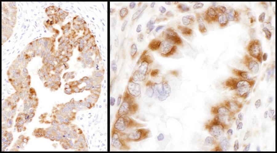 Immunohistochemistry;IDH2 Antibody[NBP3-29996]Detection of human IDH2 by immunohistochemistry. Samples: FFPE sections of human ovarian carcinoma  and lung cancer . Antibody: Affinity purified rabbit anti-IDH2  used at a dilution of 1:1,000 . Detection: DAB