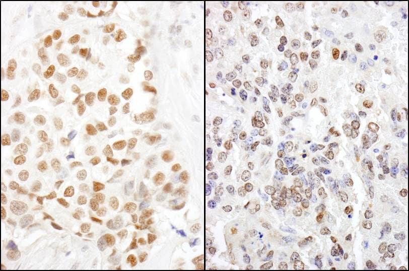 Immunohistochemistry;HMGN1/HMG14 Antibody[NBP3-29996]Detection of human and mouse HMGN1 by immunohistochemistry. Sample: FFPE section of human breast carcinoma  and mouse teratoma . Antibody: Affinity purified rabbit anti-HMGN1  used at a dilution of 1:5,000 . Detection: DAB