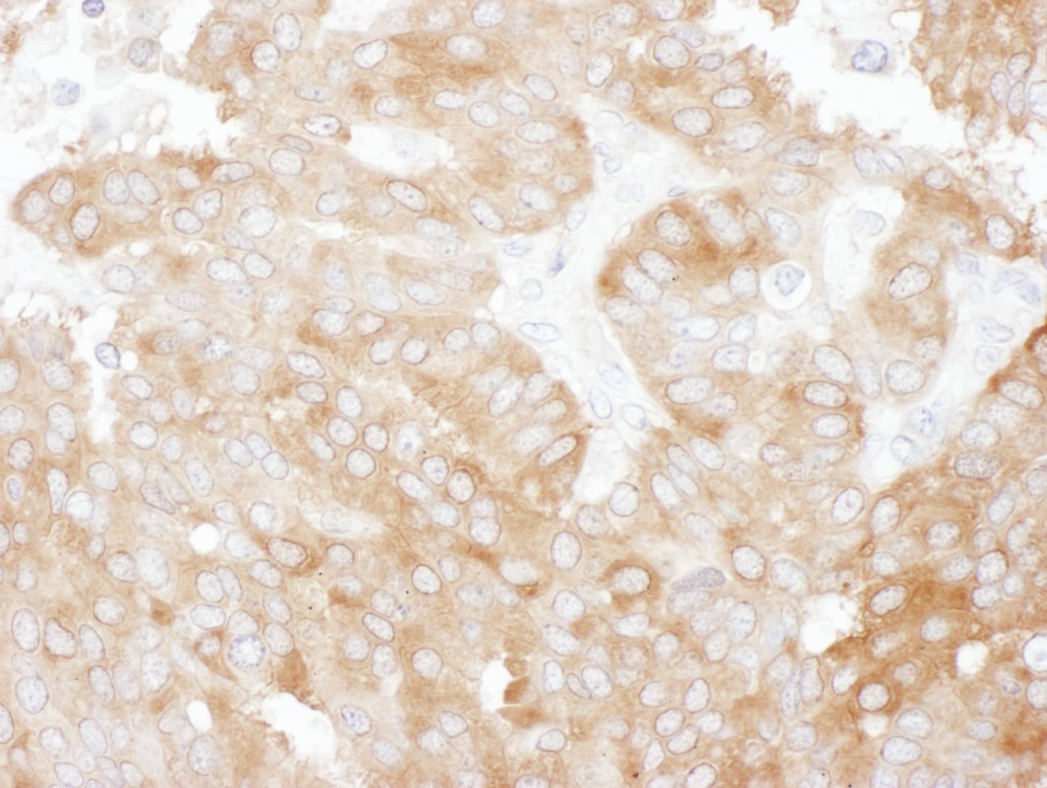 Immunohistochemistry:[NBP3-30205]-Detection of human NHERF1 by immunohistochemistry. Sample: FFPE section of human breast carcinoma. Antibody: Affinity purified rabbit anti-NHERF1 used at a dilution of 1: 200. Detection: DAB