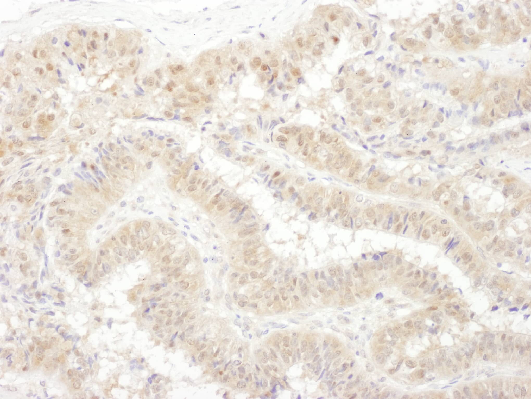 Immunohistochemistry;Tbp7 Antibody[NBP3-29997]Detection of human PSMC4 by immunohistochemistry. Sample: FFPE section of human ovarian carcinoma. Antibody: Affinity purified rabbit anti-PSMC4  used at a dilution of 1:1,000 . Detection: DAB