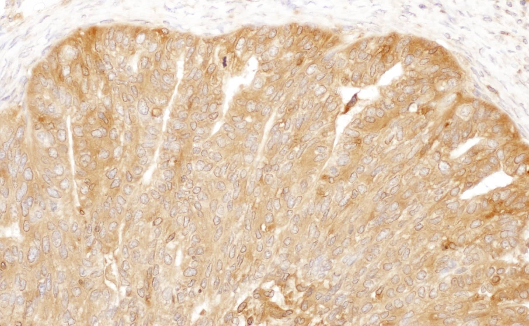 Immunohistochemistry;CAP1 Antibody[NBP3-30239]Detection of human CAP1 by immunohistochemistry. Sample: FFPE section of human ovarian carcinoma. Antibody: Affinity purified rabbit anti-CAP1  used at a dilution of 1:1,000 . Detection: DAB