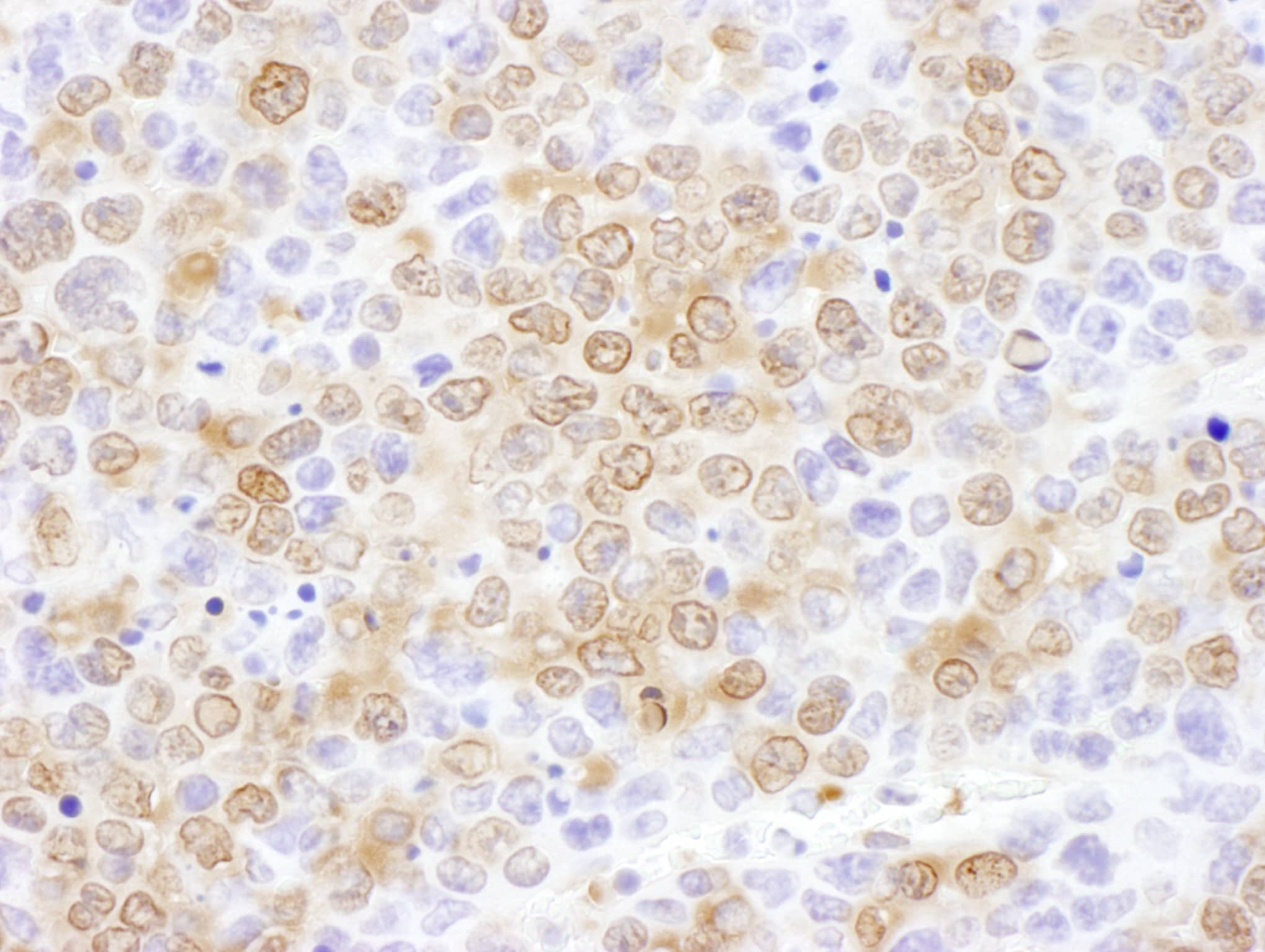 Immunohistochemistry;NUDC Antibody[NBP3-30241]Detection of mouse NUDC by immunohistochemistry. Sample: FFPE section of mouse renal cell carcinoma. Antibody: Affinity purified rabbit anti-NUDC  used at a dilution of 1:1,000 . Detection: DAB