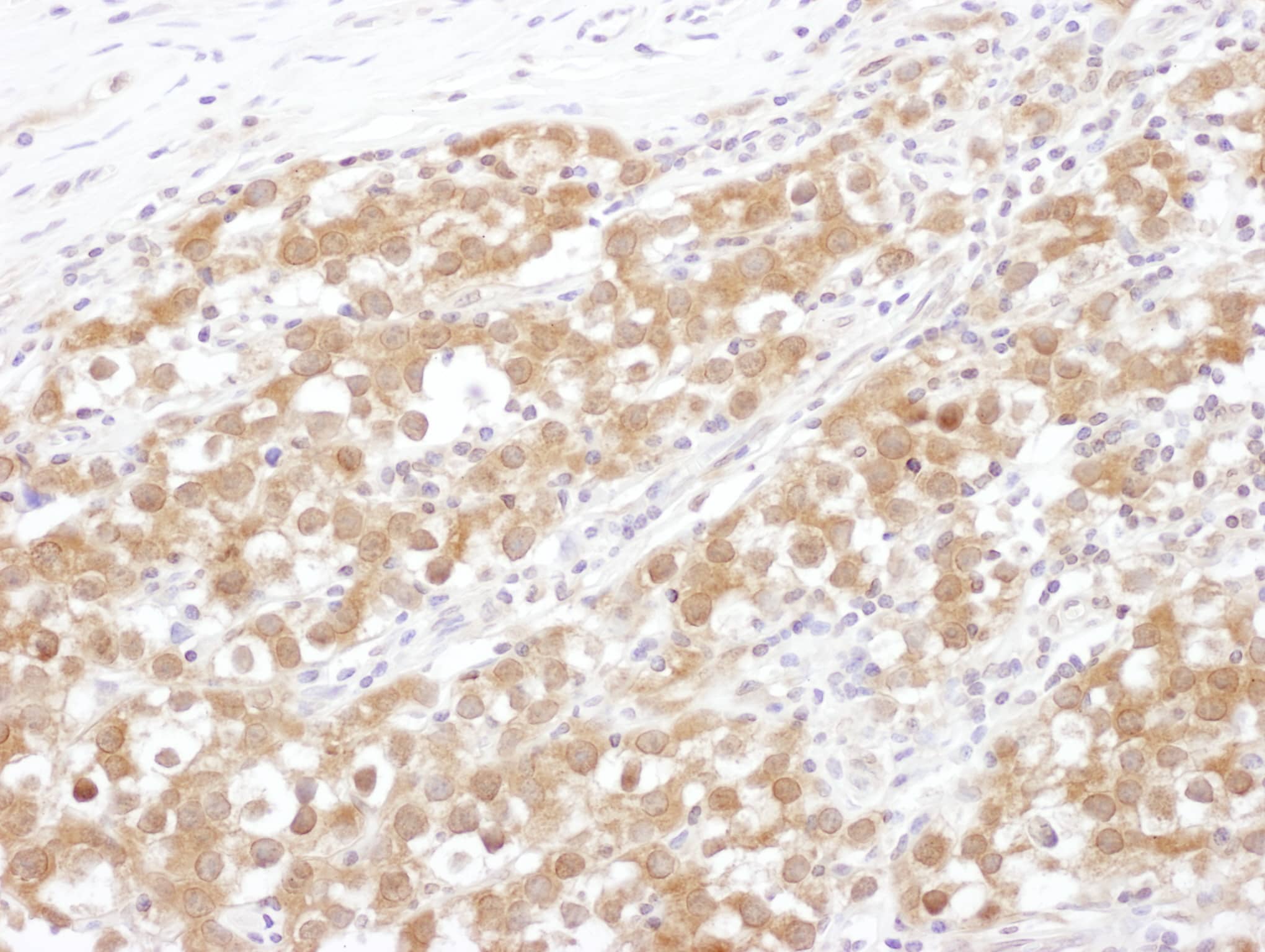 Immunohistochemistry;NUDC Antibody[NBP3-30240]Detection of human NUDC by immunohistochemistry. Sample: FFPE section of human testicular seminoma. Antibody: Affinity purified rabbit anti-NUDC  used at a dilution of 1:1,000 . Detection: DAB