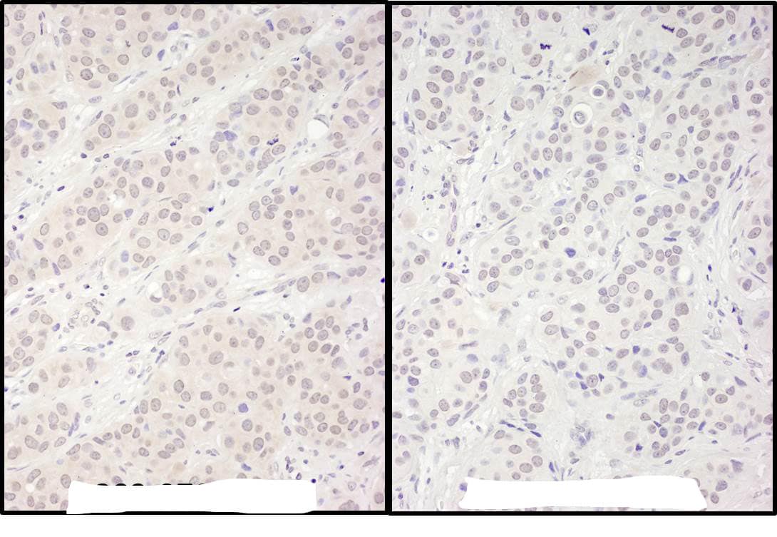 Immunohistochemistry:[NBP3-30243]-Detection of human DDX56 by immunohistochemistry. Samples: FFPE serial sections of human breast carcinoma. Antibody: Affinity purified rabbit anti-DDX56 used at a dilution of 1: 1,000. Detection: DAB