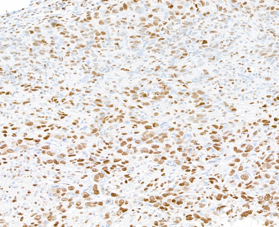 Immunohistochemistry:[NBP3-30289]-Detection of human PML by immunohistochemistry. Sample: FFPE section of human breast carcinoma. Antibody: Affinity purified rabbit anti-PML used at a dilution of 1: 1,000. Detection: DAB