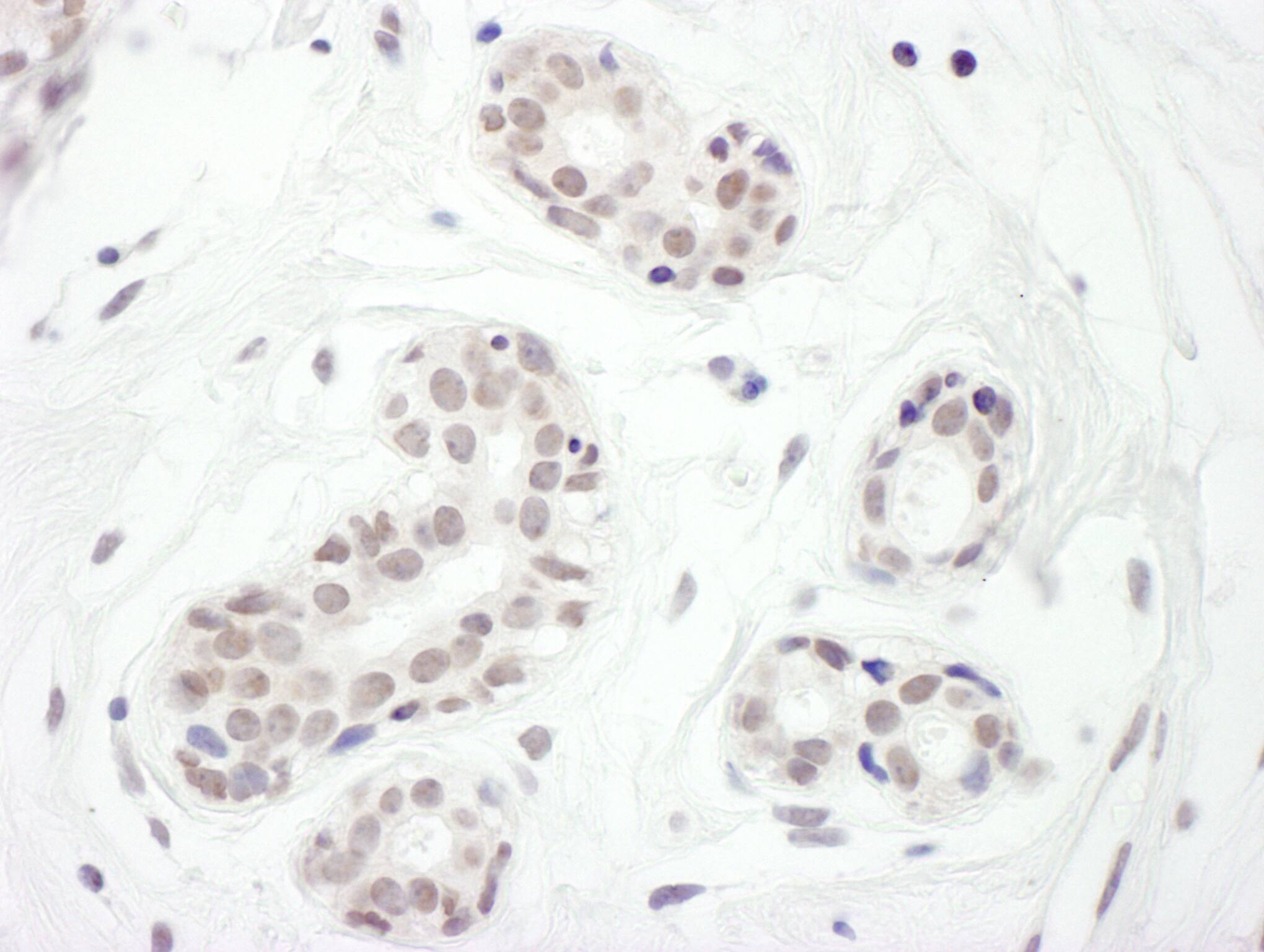 Immunohistochemistry:[NBP3-30290]-Detection of human FOXC1 by immunohistochemistry. Sample: FFPE section of human breast carcinoma. Antibody: Affinity purified rabbit anti-FOXC1 used at a dilution of 1: 200. Detection: DAB. Counterstain: hematoxylin.