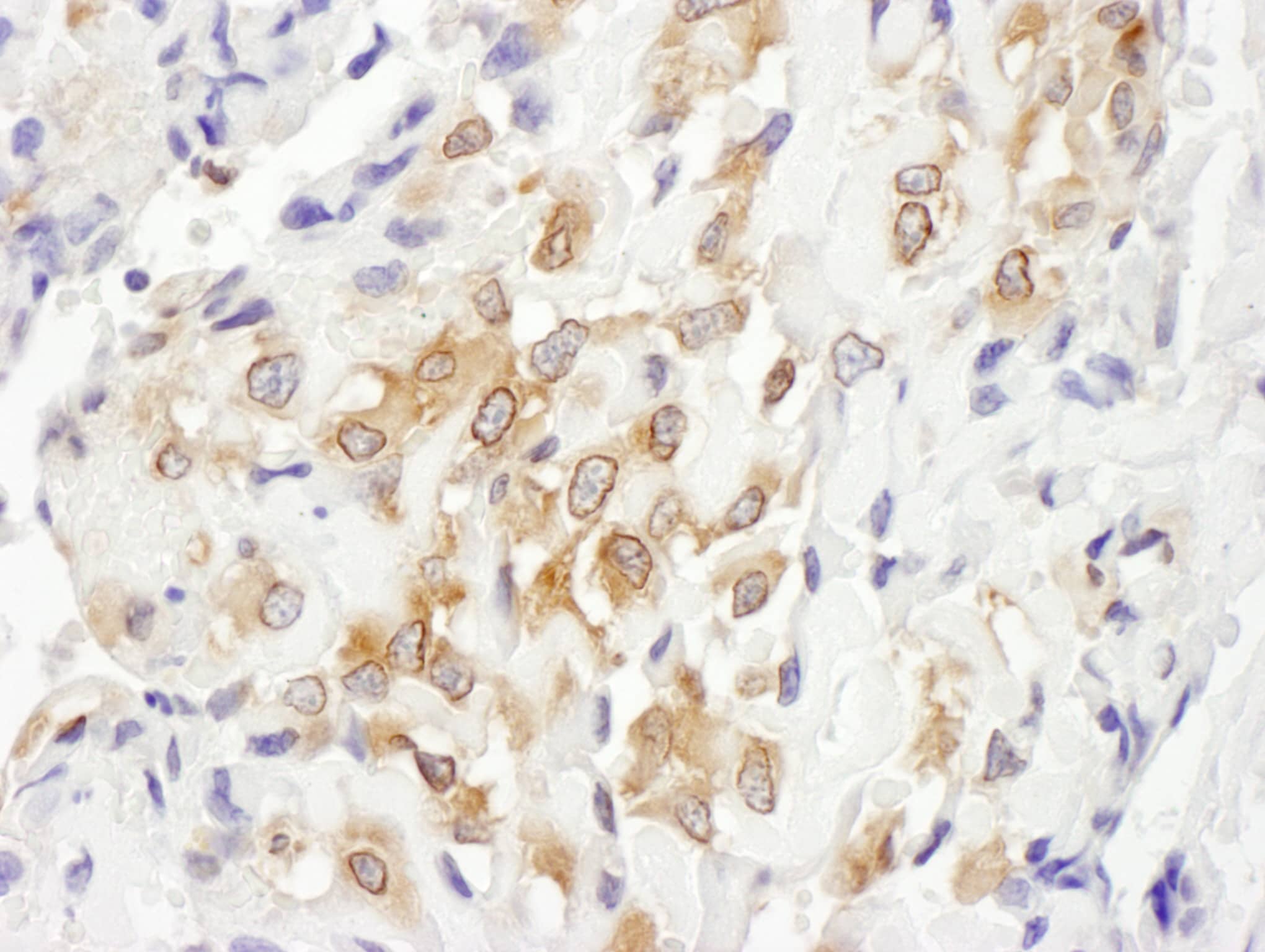Immunohistochemistry;Septin-7 Antibody[NBP3-30288]Detection of human Septin 7 by immunohistochemistry. Sample: FFPE section of human osteosarcoma. Antibody: Affinity purified rabbit anti-Septin 7  used at a dilution of 1:1,000 . Detection: DAB