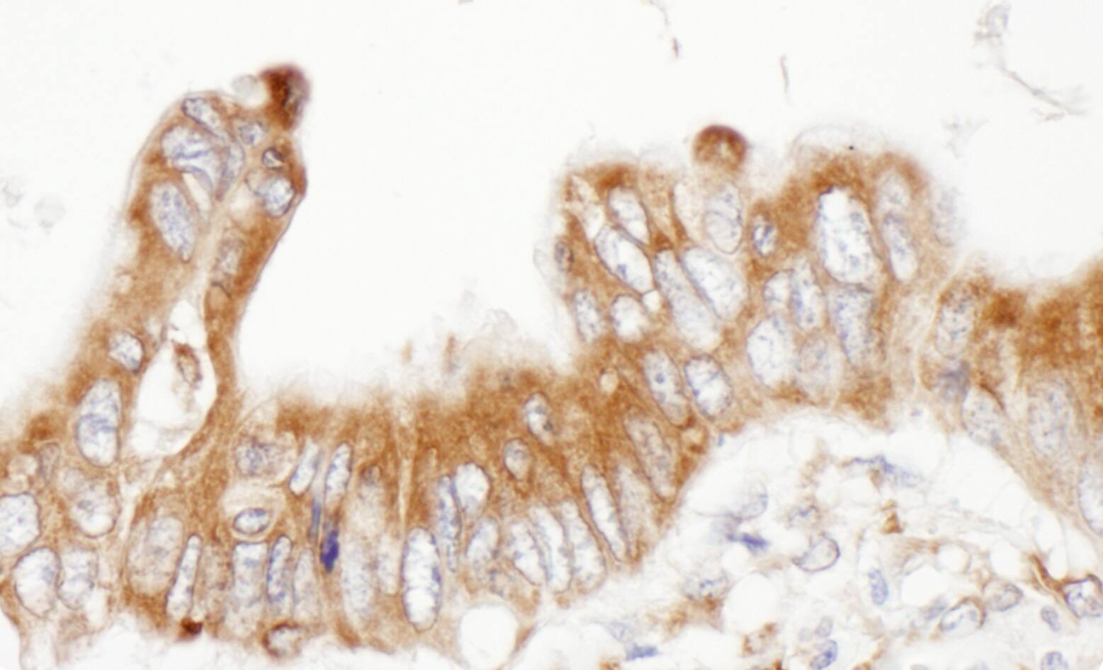 Immunohistochemistry;PDIA6 Antibody[NBP3-30316]Detection of human ERp5 by immunohistochemistry. Sample: FFPE section of human colon carcinoma. Antibody: Affinity purified rabbit anti-ERp5  used at a dilution of 1:5,000 . Detection: DAB